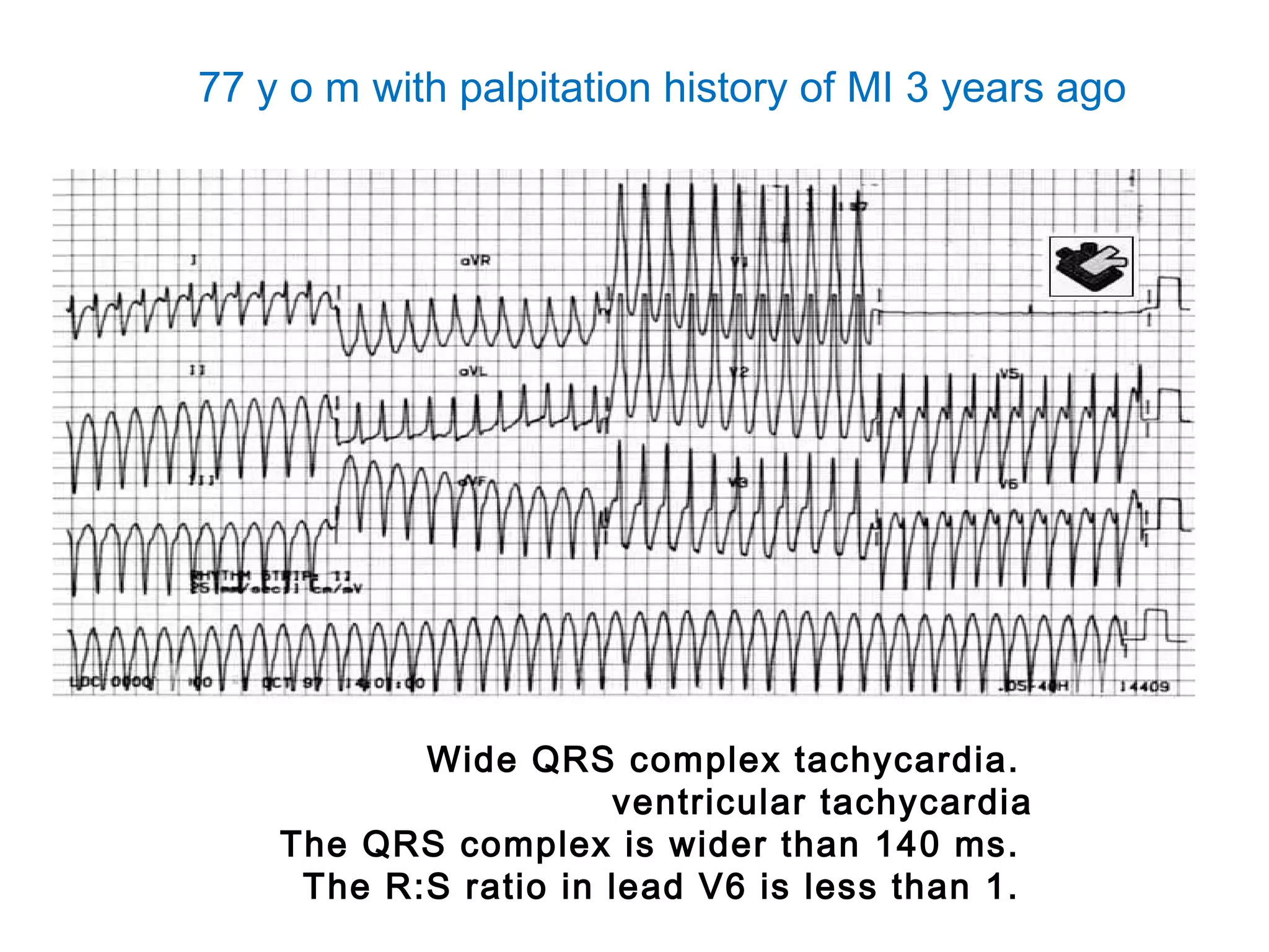 77 y o m with palpitation history of MI 3 years ago

Wide QRS complex tachycardia.
ventricular tachycardia
The QRS complex is wider than 140 ms.
The R:S ratio in lead V6 is less than 1.

 