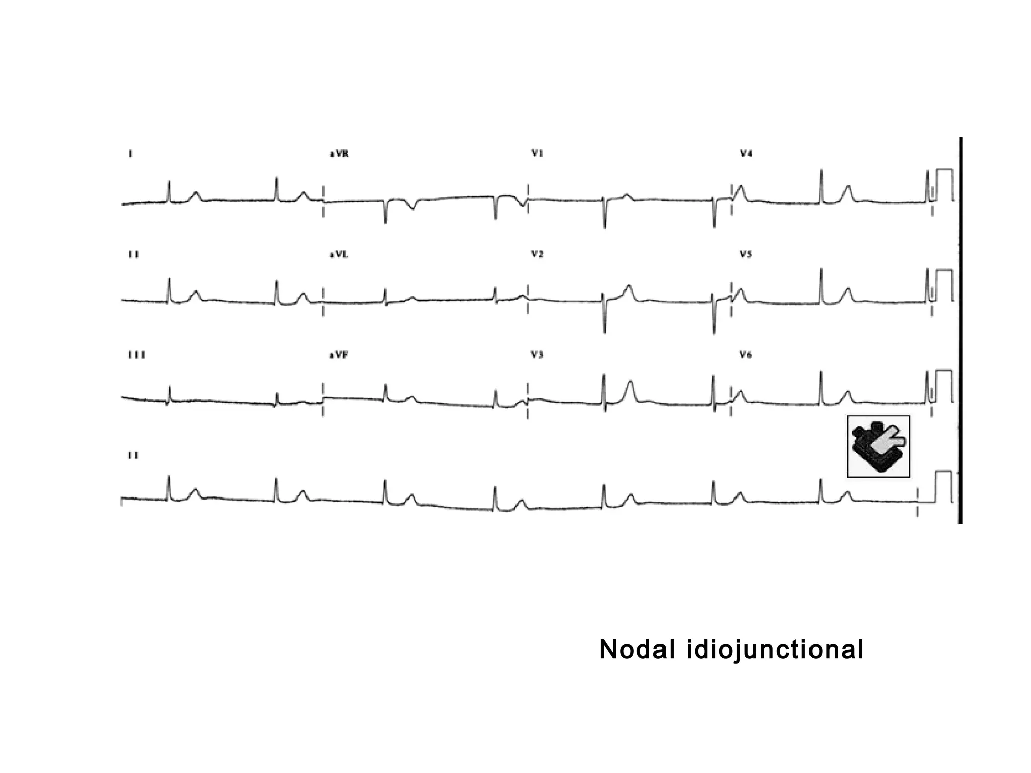 Nodal idiojunctional

 
