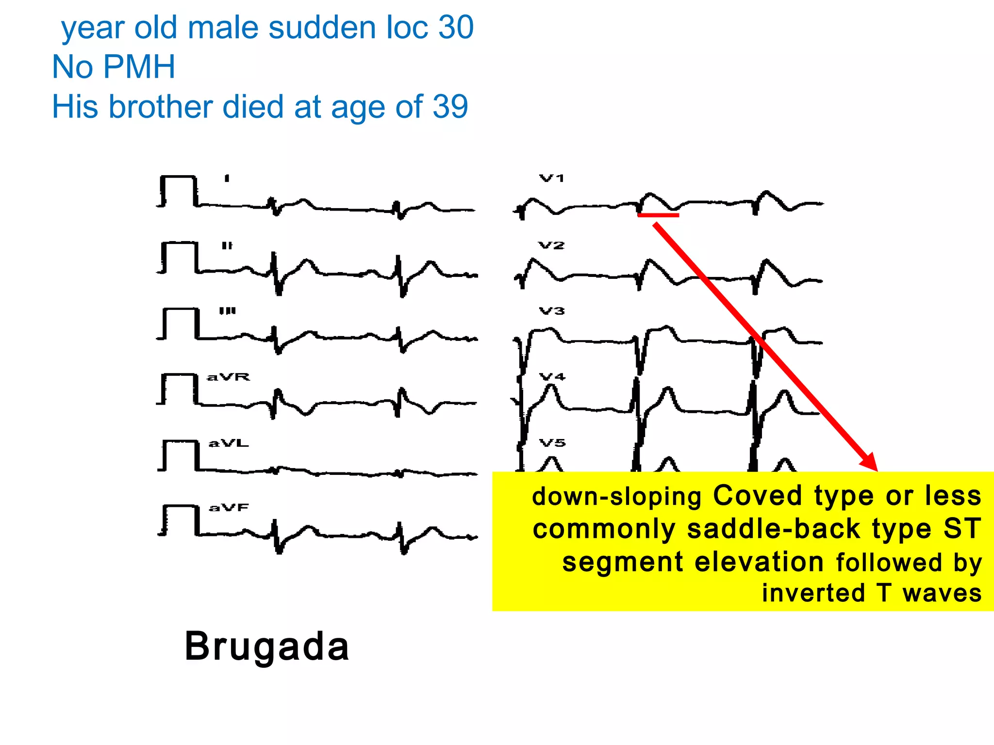 year old male sudden loc 30
No PMH
His brother died at age of 39

down-sloping Coved type or less

commonly saddle-back type ST
segment elevation followed by
inverted T waves

Brugada

 