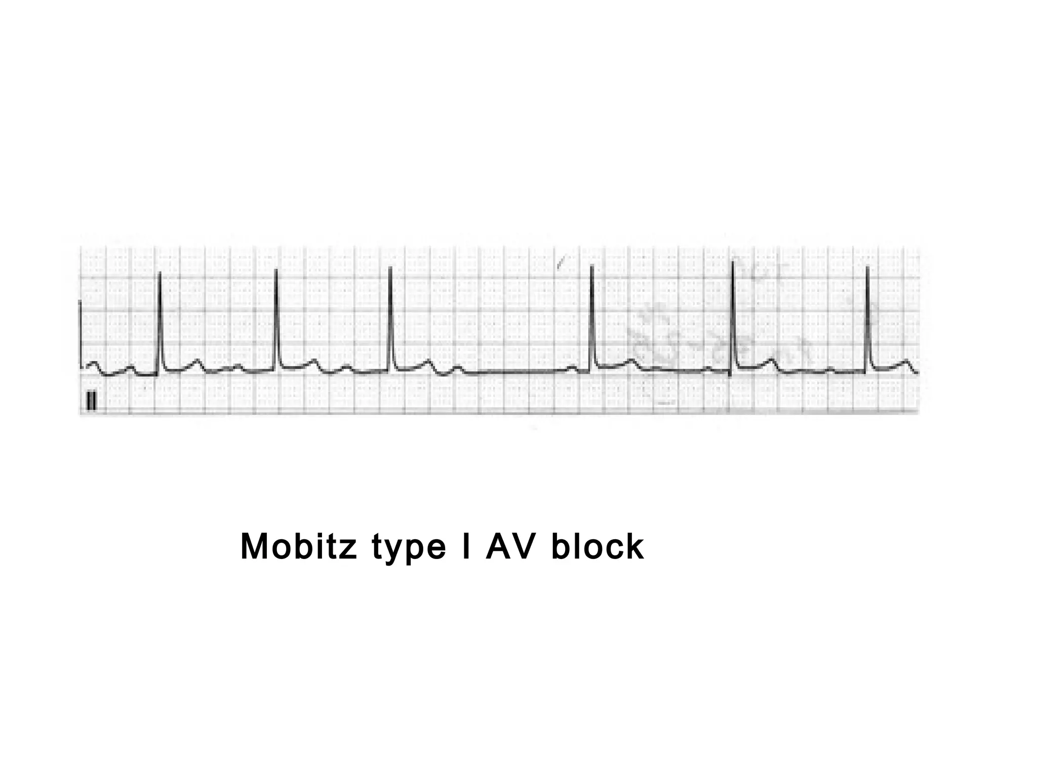 Mobitz type I AV block

 