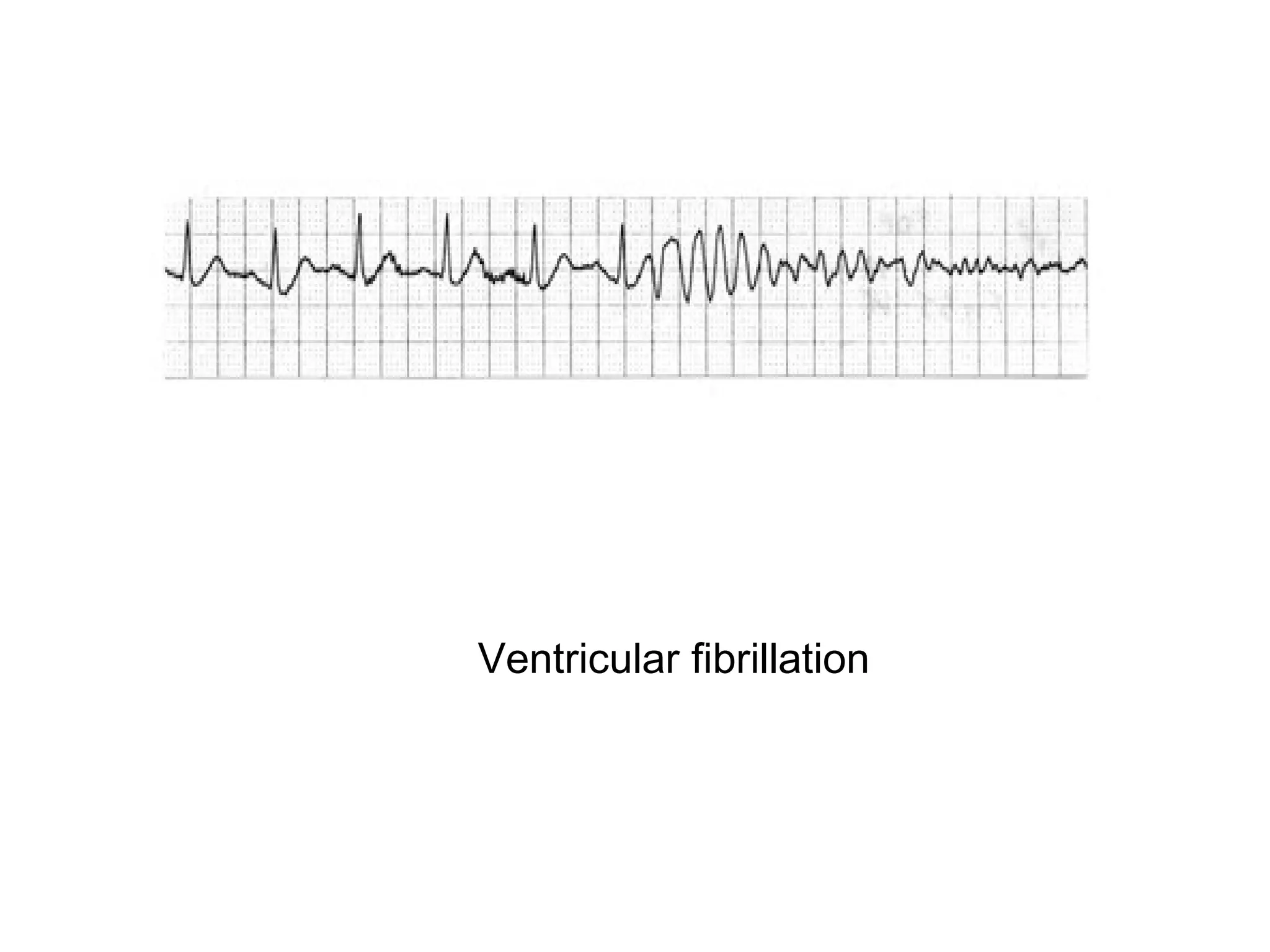 Ventricular fibrillation

 