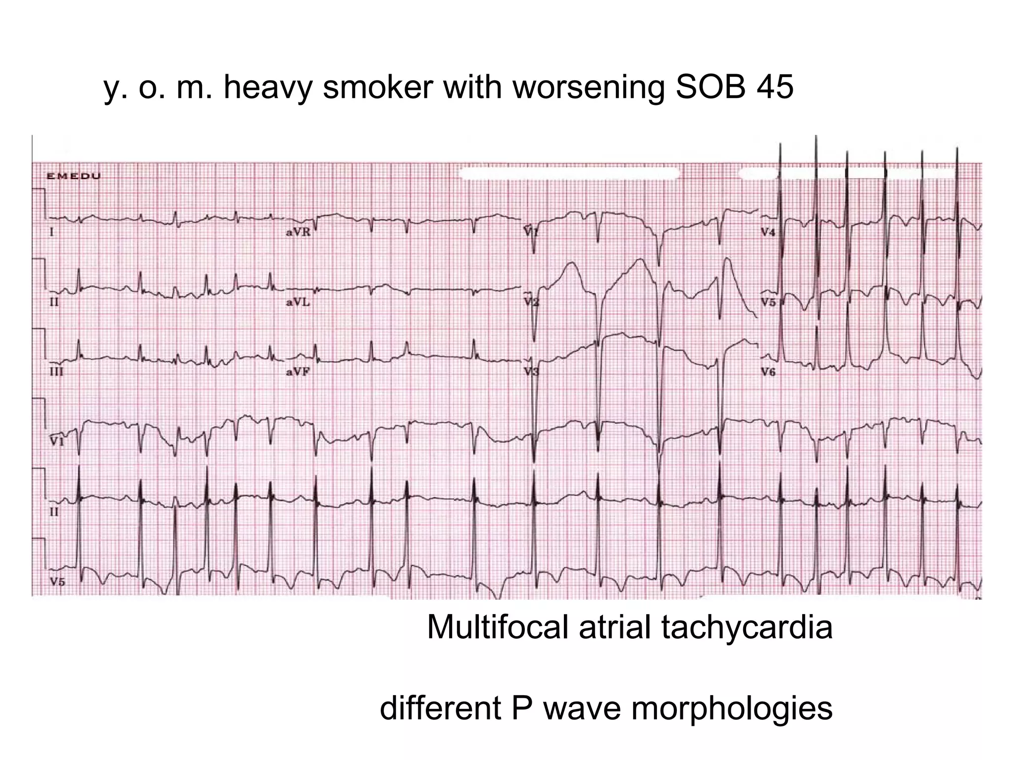 y. o. m. heavy smoker with worsening SOB 45

Multifocal atrial tachycardia
different P wave morphologies

 
