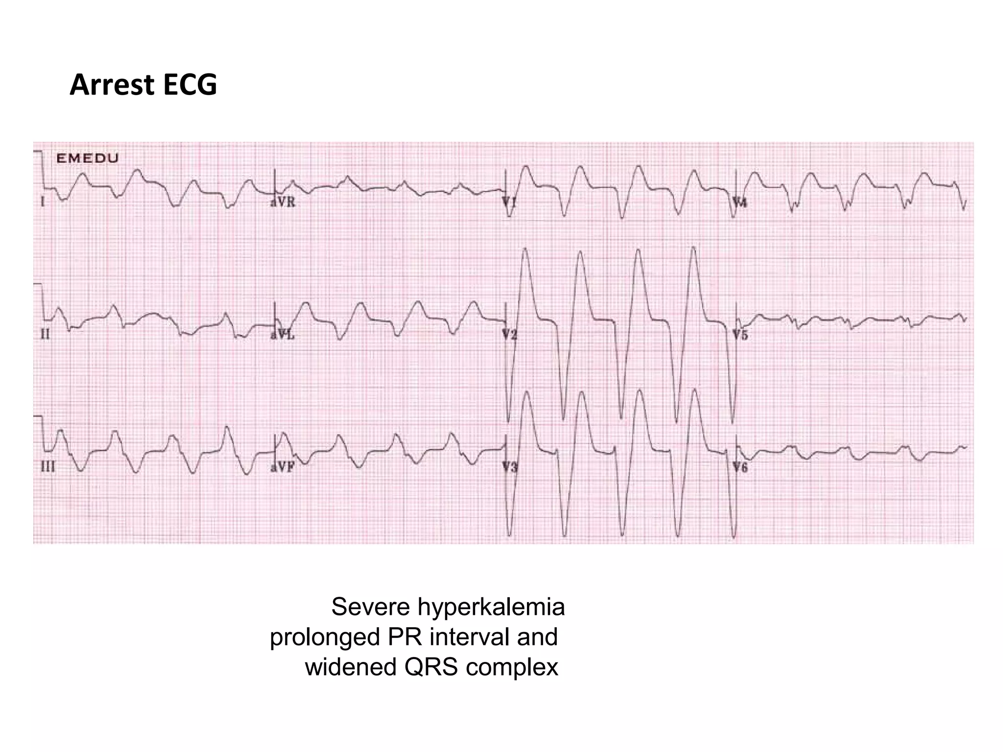 Arrest ECG

Severe hyperkalemia
prolonged PR interval and
widened QRS complex

 