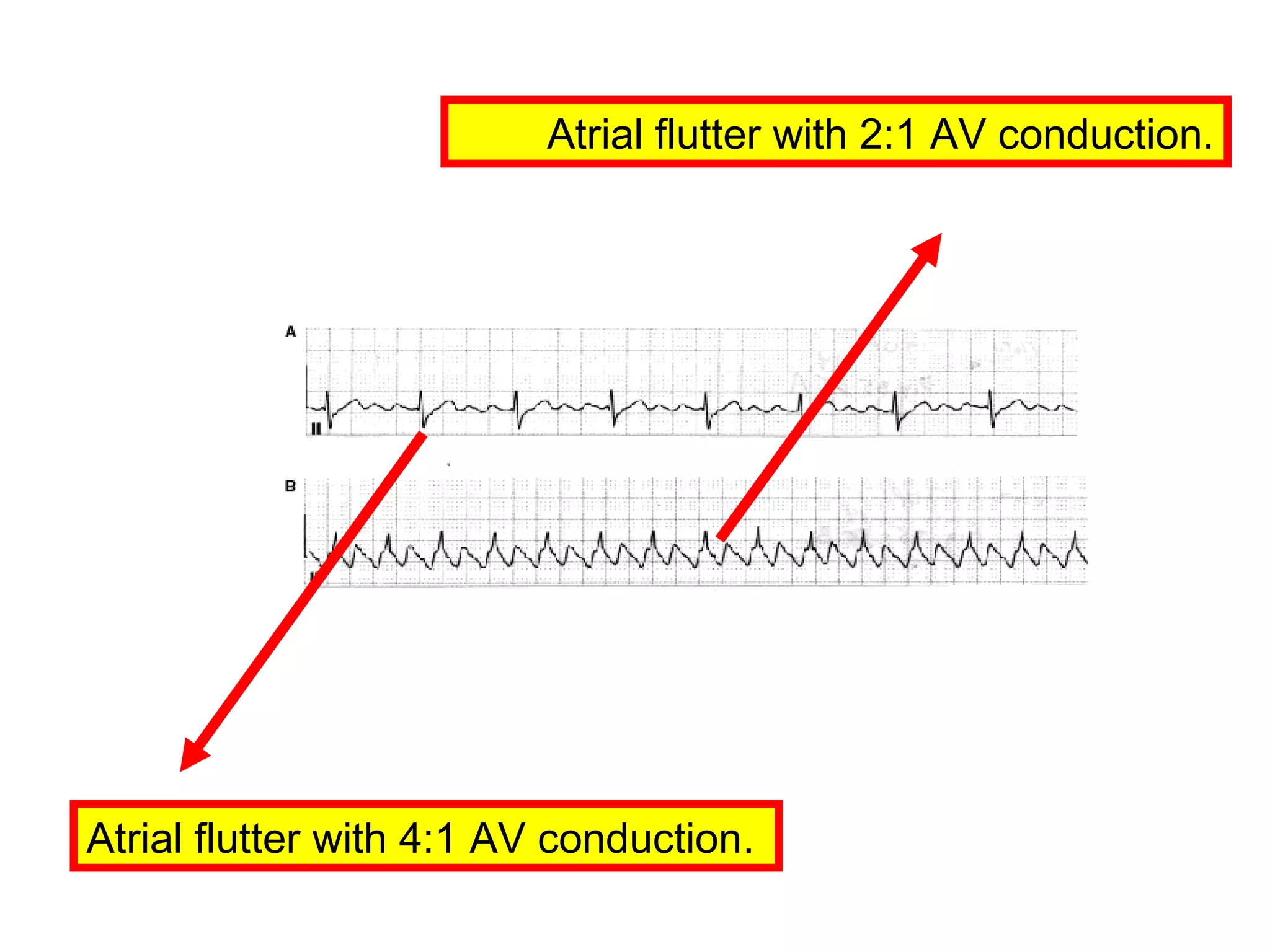 Atrial flutter with 2:1 AV conduction.

Atrial flutter with 4:1 AV conduction.

 