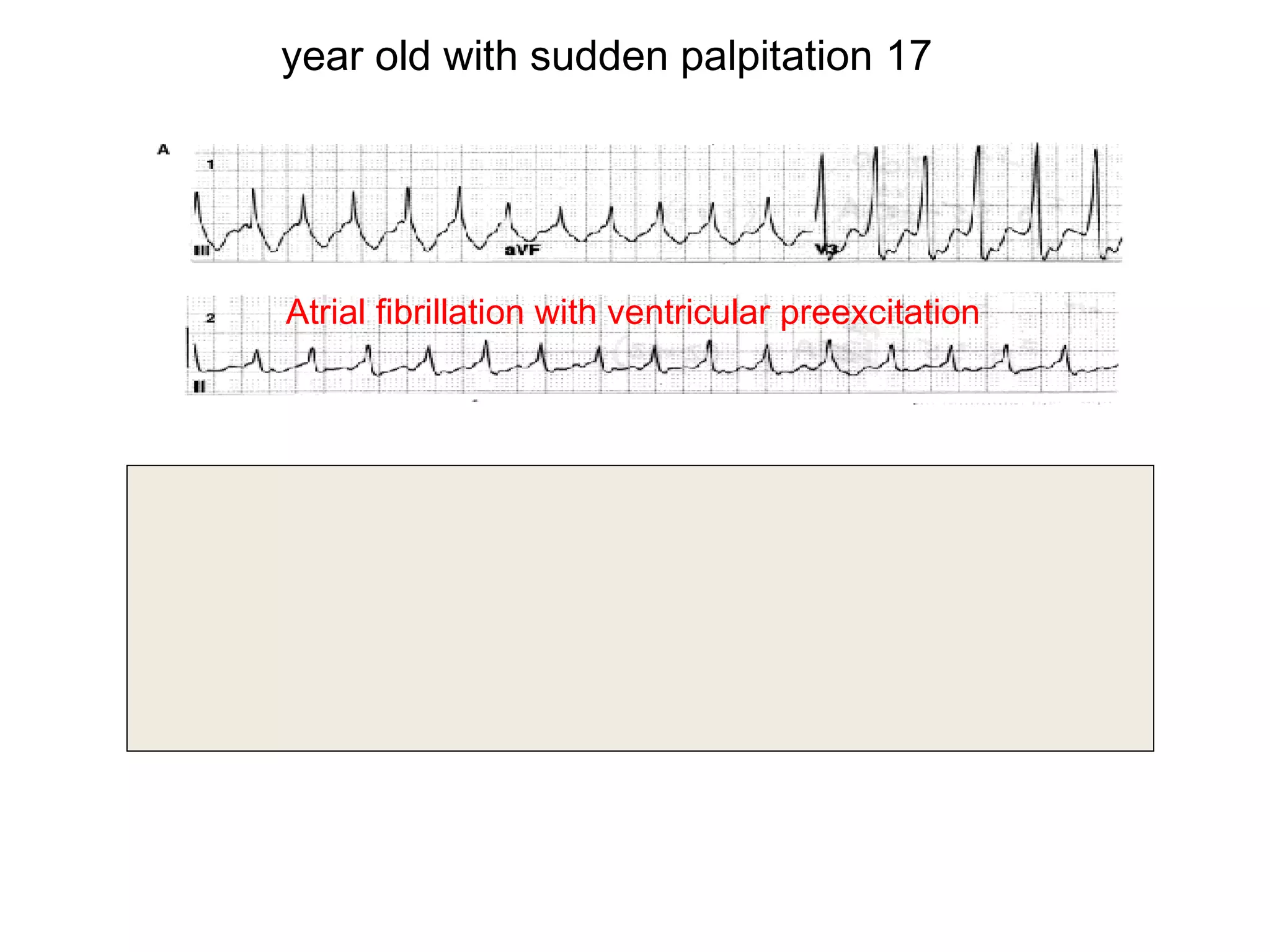 year old with sudden palpitation 17

Atrial fibrillation with ventricular preexcitation

.S. rhythm with ventricular preexcitation

 