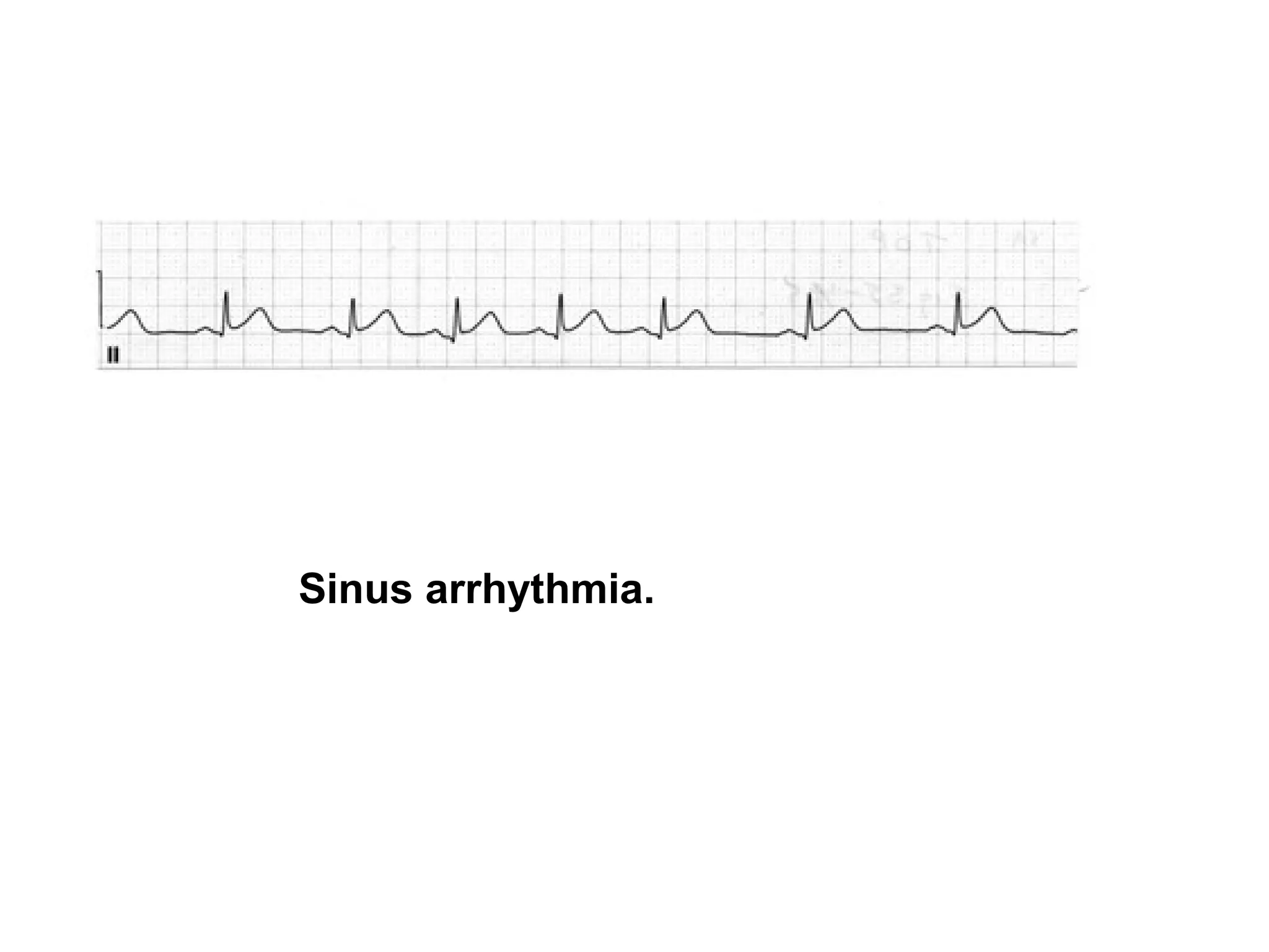 Sinus arrhythmia.

 