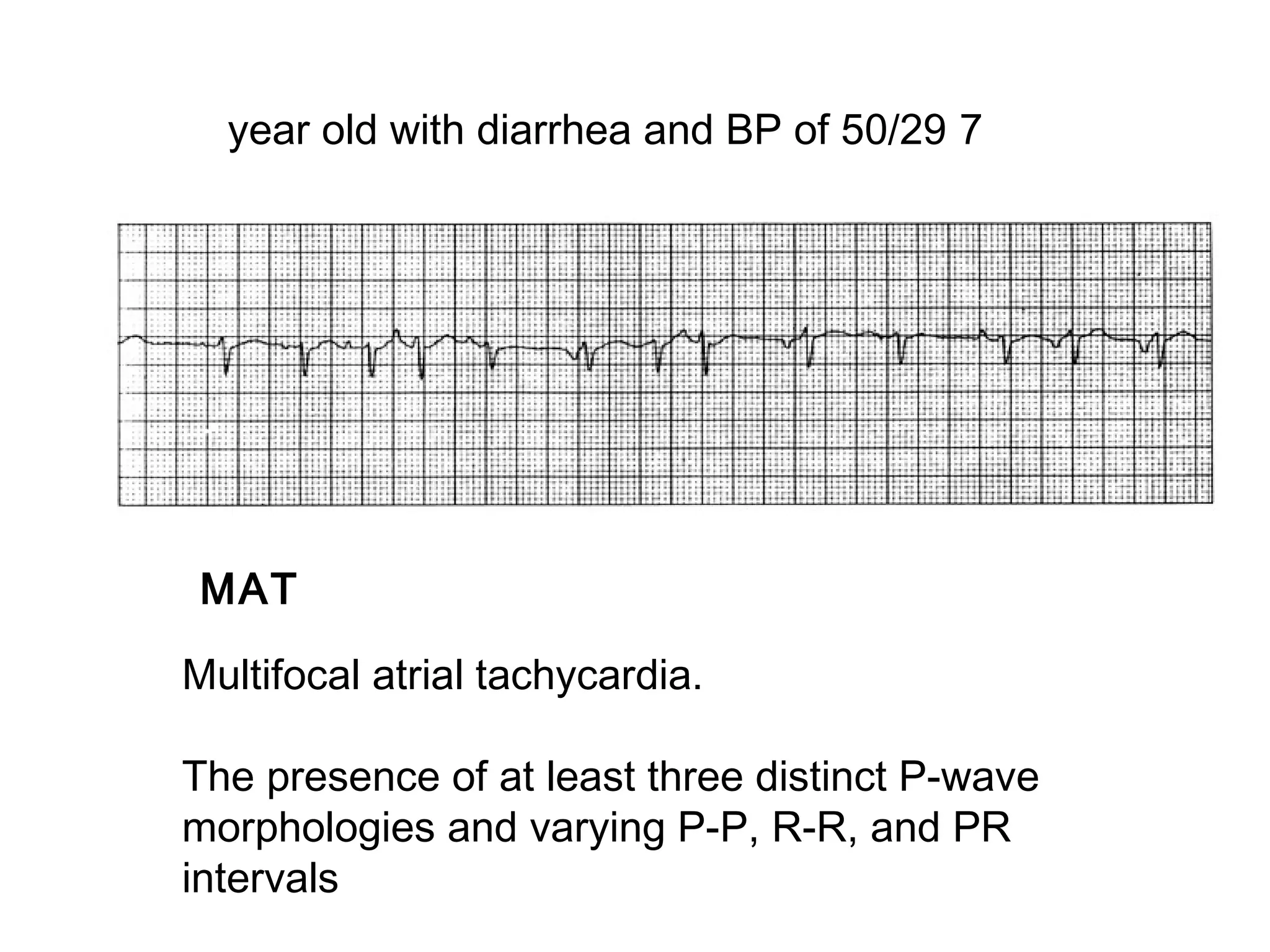 year old with diarrhea and BP of 50/29 7

MAT
Multifocal atrial tachycardia.
The presence of at least three distinct P-wave
morphologies and varying P-P, R-R, and PR
intervals

 