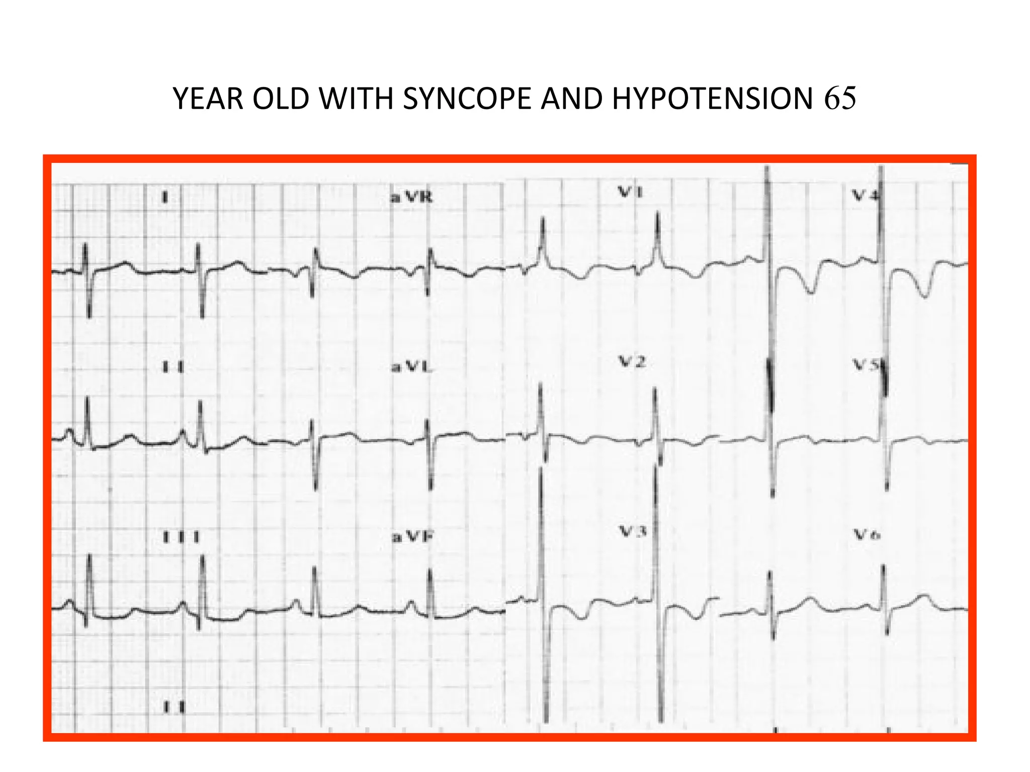 YEAR OLD WITH SYNCOPE AND HYPOTENSION 65

 