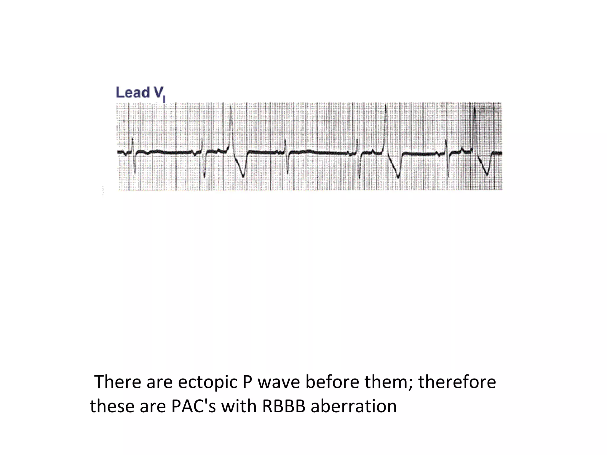 There are ectopic P wave before them; therefore
these are PAC's with RBBB aberration

 