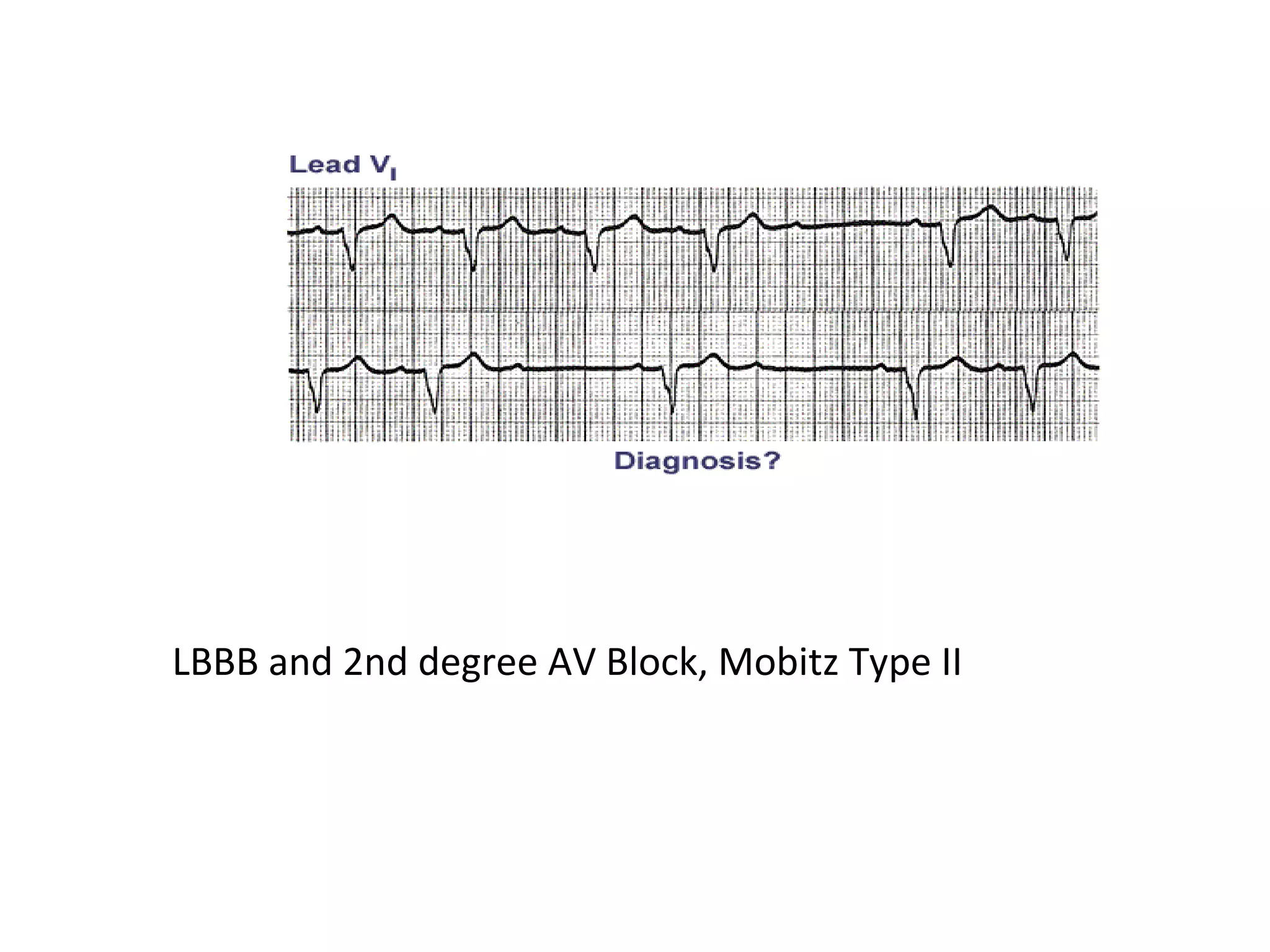 LBBB and 2nd degree AV Block, Mobitz Type II

 