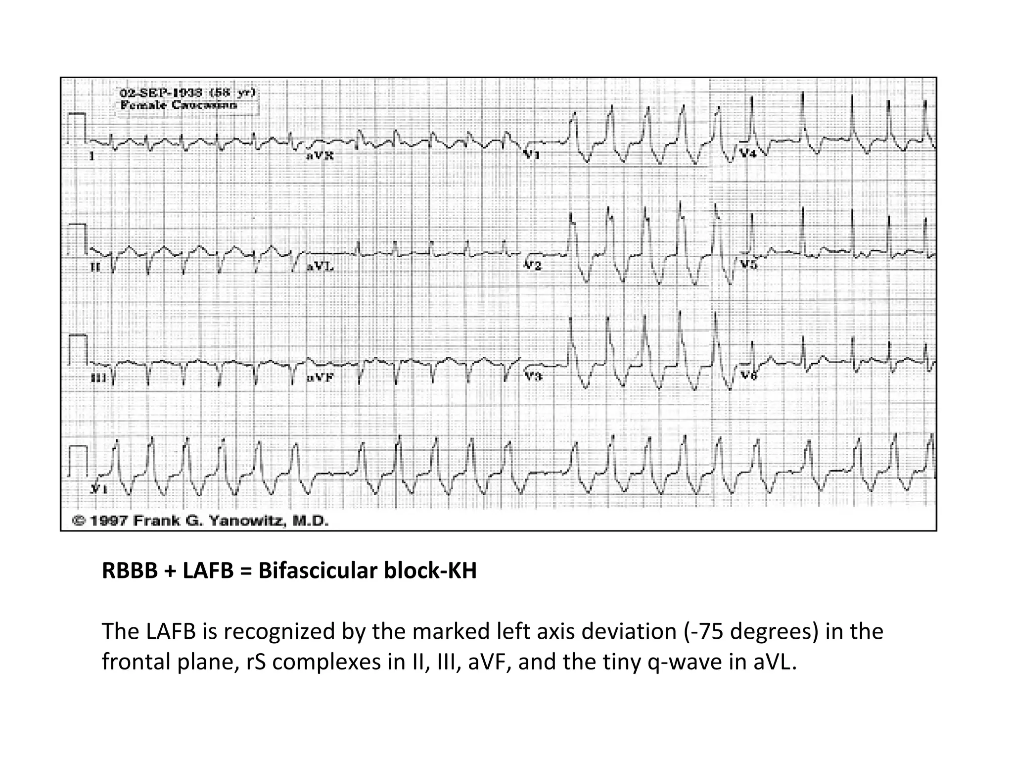 RBBB + LAFB = Bifascicular block-KH
The LAFB is recognized by the marked left axis deviation (-75 degrees) in the
frontal plane, rS complexes in II, III, aVF, and the tiny q-wave in aVL.

 