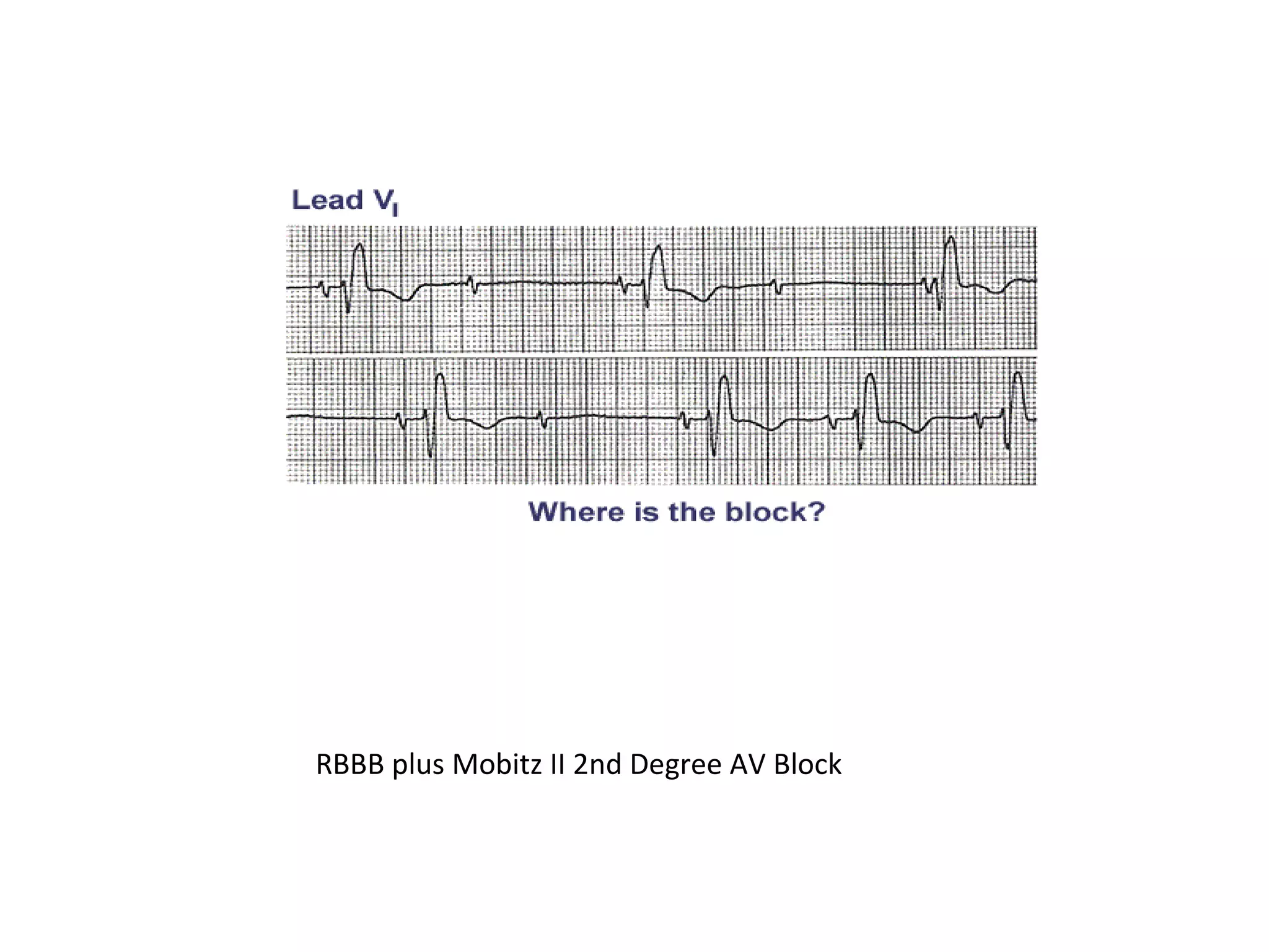 RBBB plus Mobitz II 2nd Degree AV Block

 