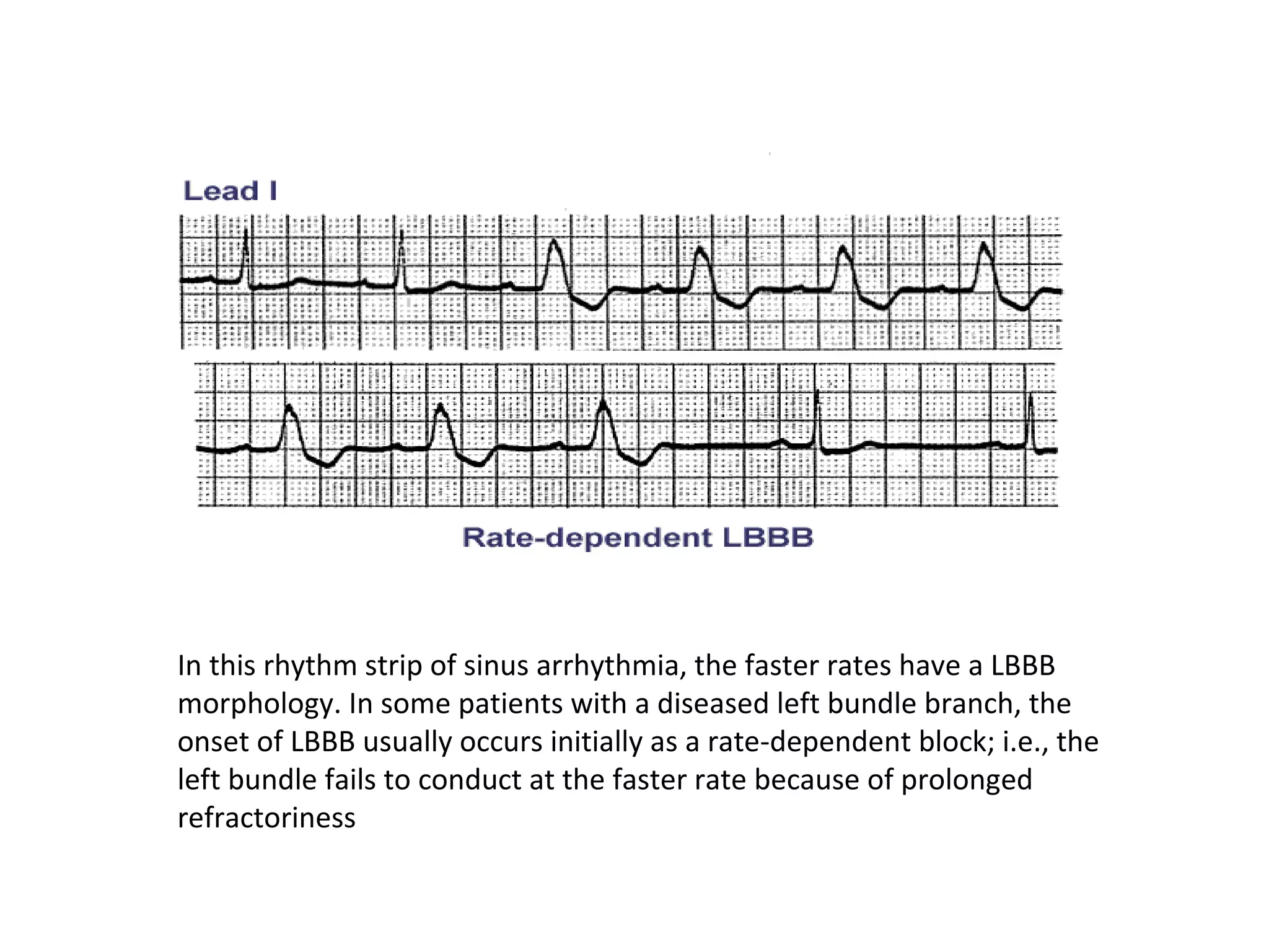 In this rhythm strip of sinus arrhythmia, the faster rates have a LBBB
morphology. In some patients with a diseased left bundle branch, the
onset of LBBB usually occurs initially as a rate-dependent block; i.e., the
left bundle fails to conduct at the faster rate because of prolonged
refractoriness

 