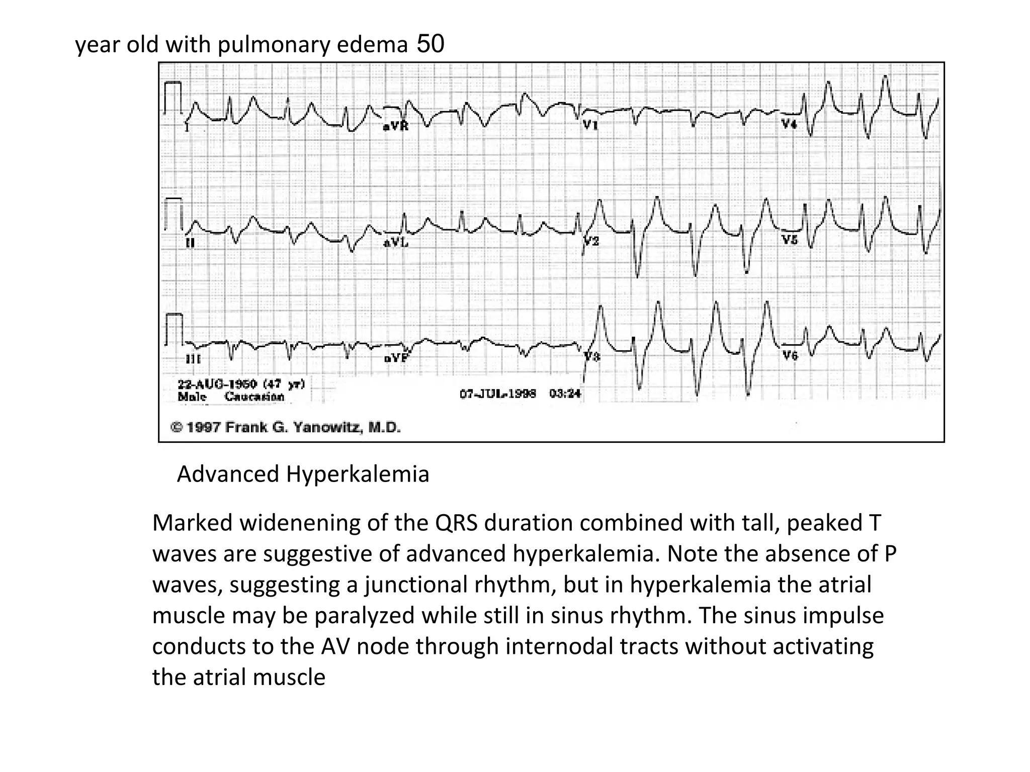 year old with pulmonary edema 50

Advanced Hyperkalemia
Marked widenening of the QRS duration combined with tall, peaked T
waves are suggestive of advanced hyperkalemia. Note the absence of P
waves, suggesting a junctional rhythm, but in hyperkalemia the atrial
muscle may be paralyzed while still in sinus rhythm. The sinus impulse
conducts to the AV node through internodal tracts without activating
the atrial muscle

 
