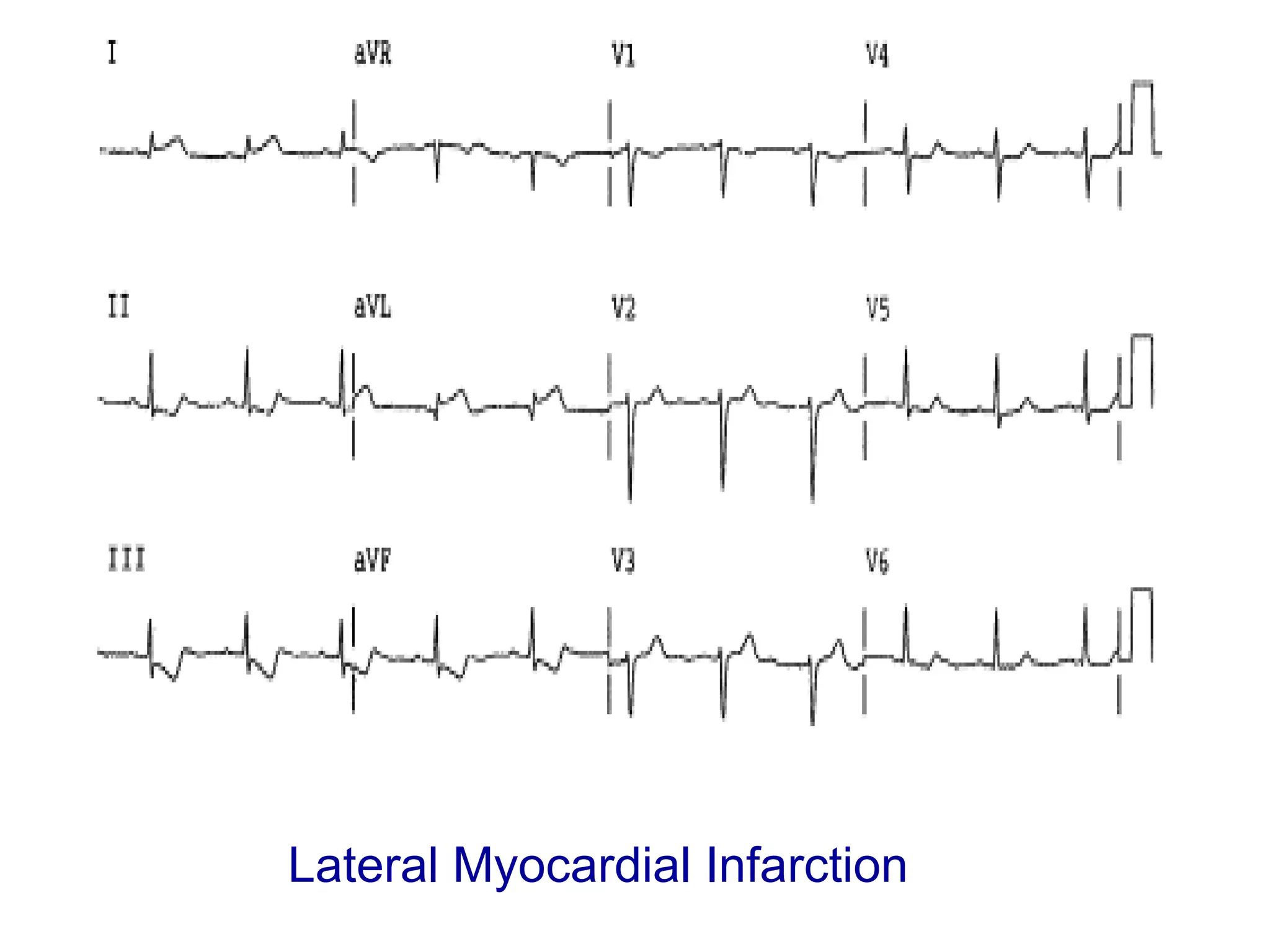 Lateral Myocardial Infarction

 