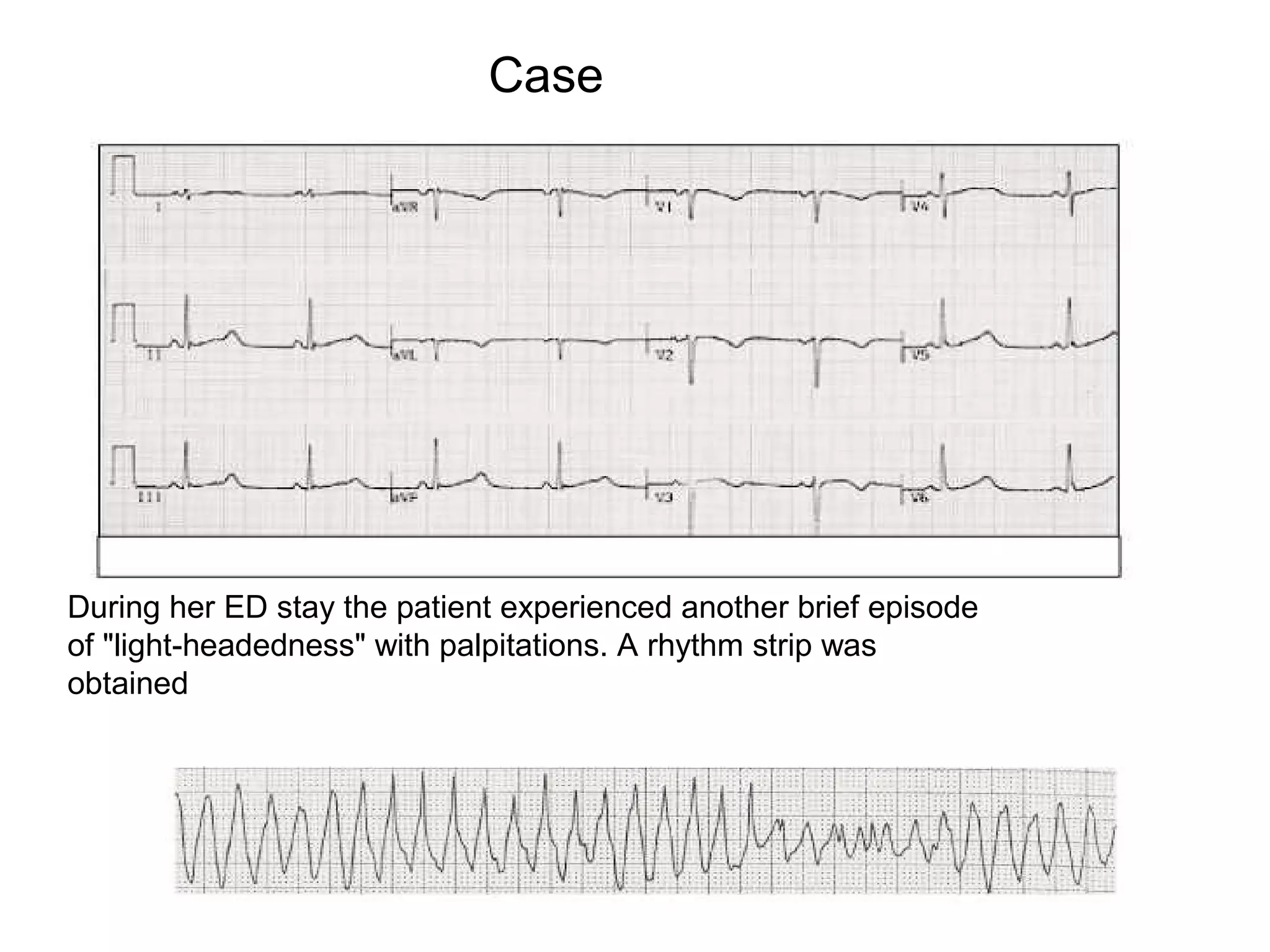 Case

During her ED stay the patient experienced another brief episode
of "light-headedness" with palpitations. A rhythm strip was
obtained

 