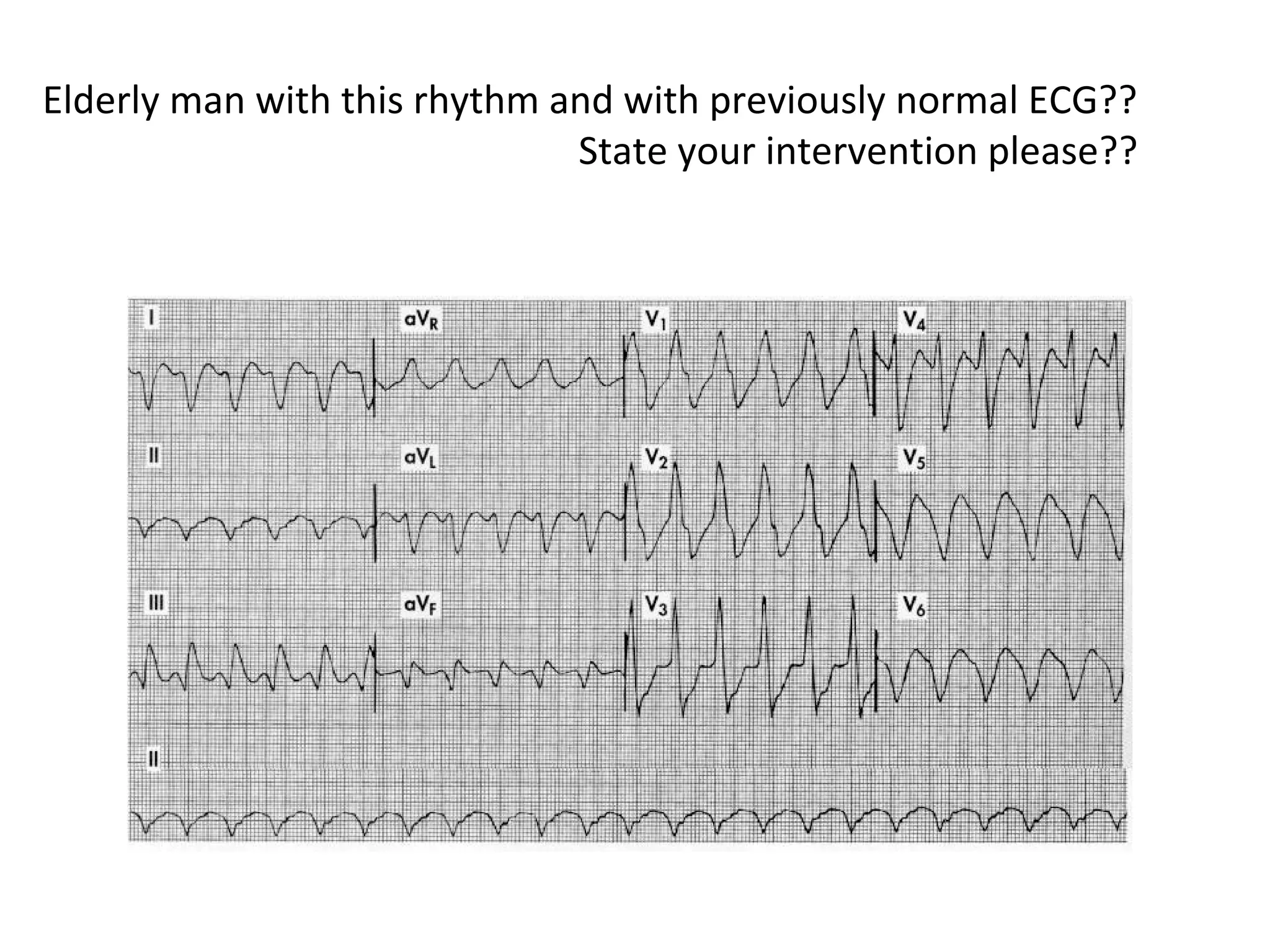 Elderly man with this rhythm and with previously normal ECG??
State your intervention please??

 
