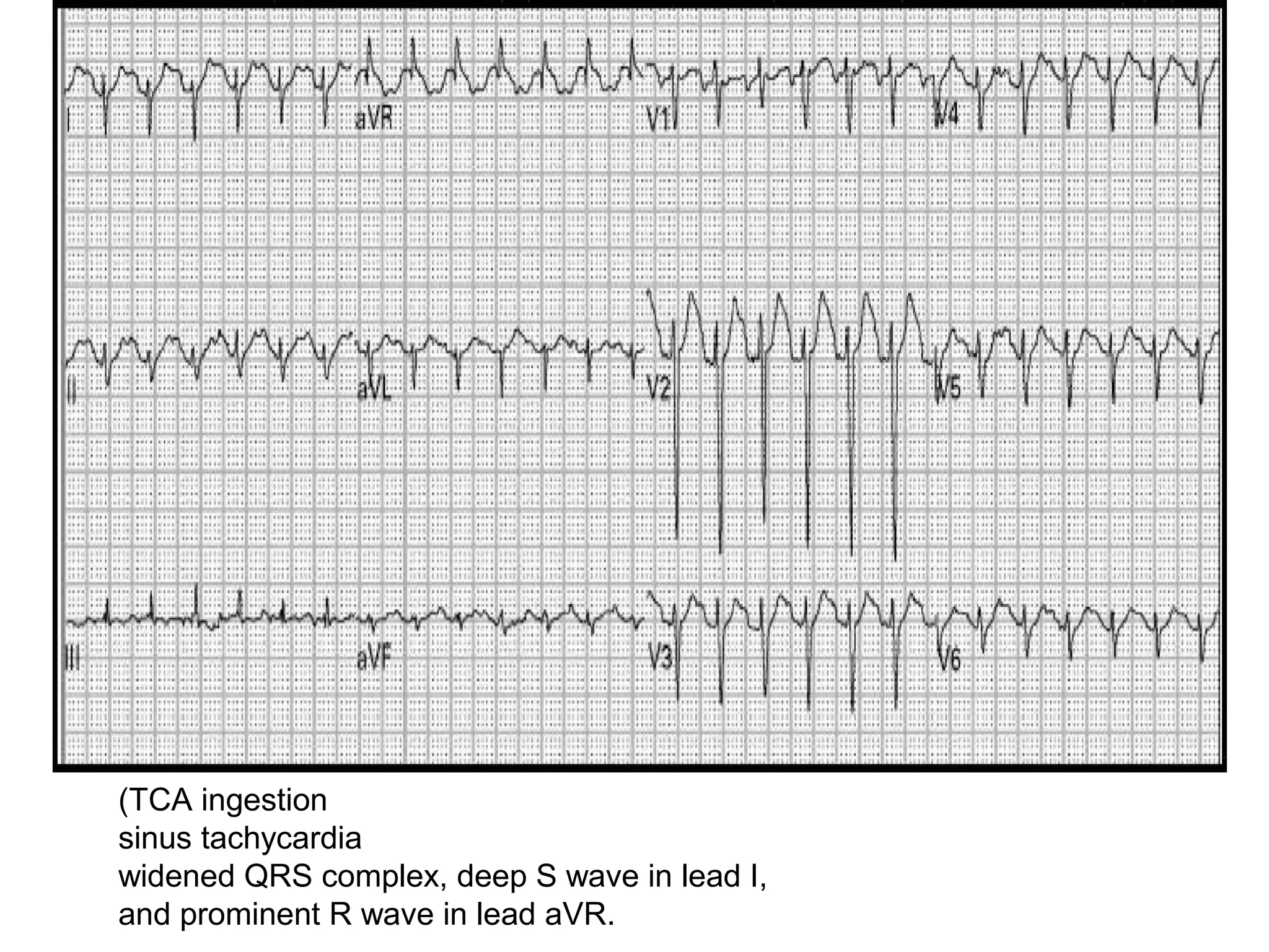 (TCA ingestion
sinus tachycardia
widened QRS complex, deep S wave in lead I,
and prominent R wave in lead aVR.

 