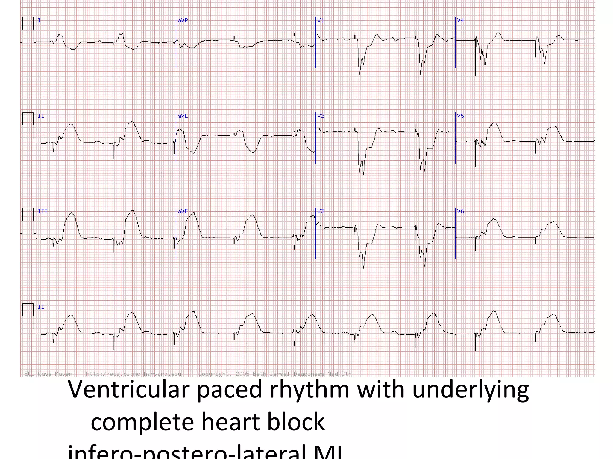 Ventricular paced rhythm with underlying
complete heart block

 