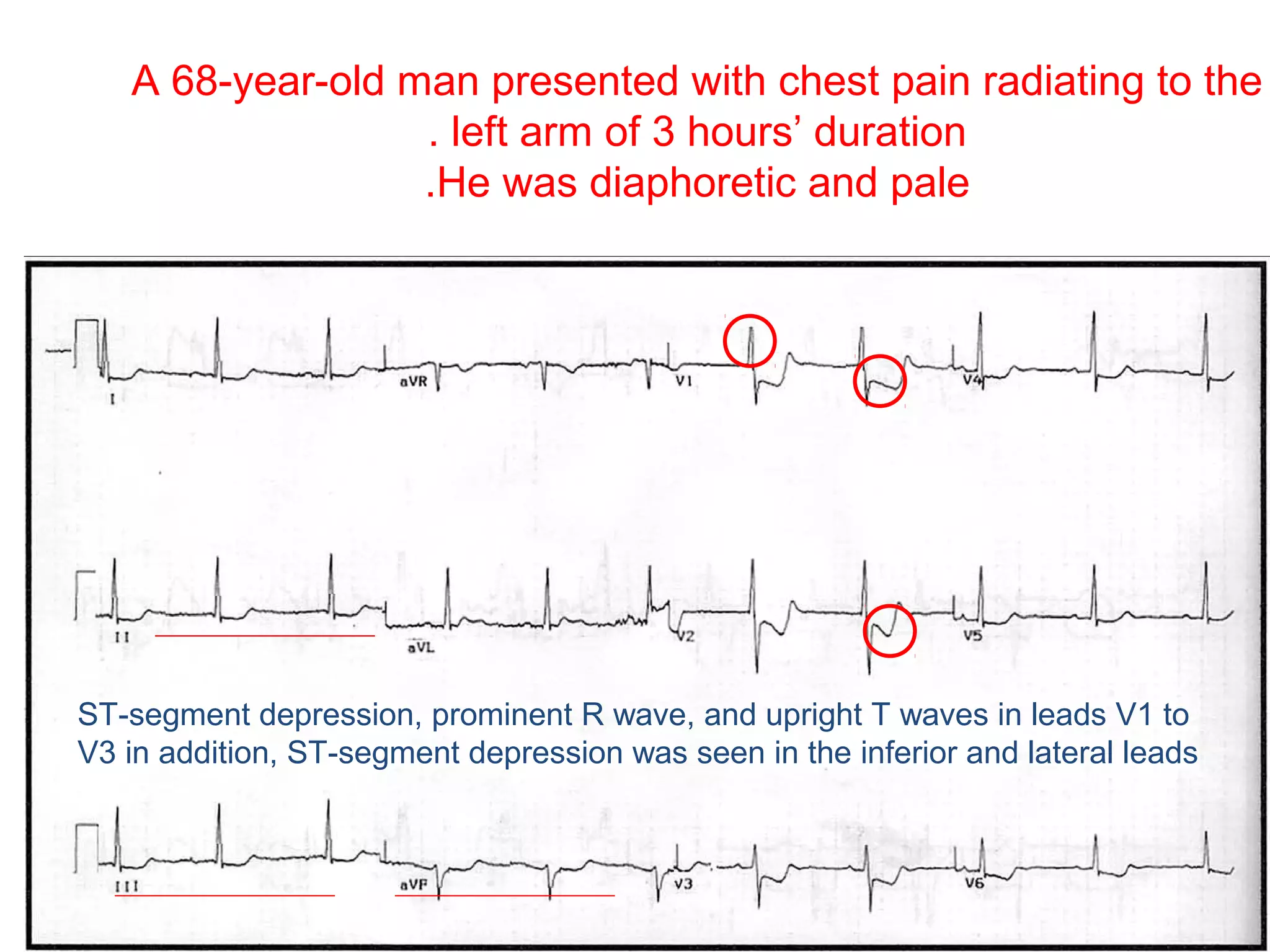 A 68-year-old man presented with chest pain radiating to the
. left arm of 3 hours’ duration
.He was diaphoretic and pale

ST-segment depression, prominent R wave, and upright T waves in leads V1 to
V3 in addition, ST-segment depression was seen in the inferior and lateral leads

 