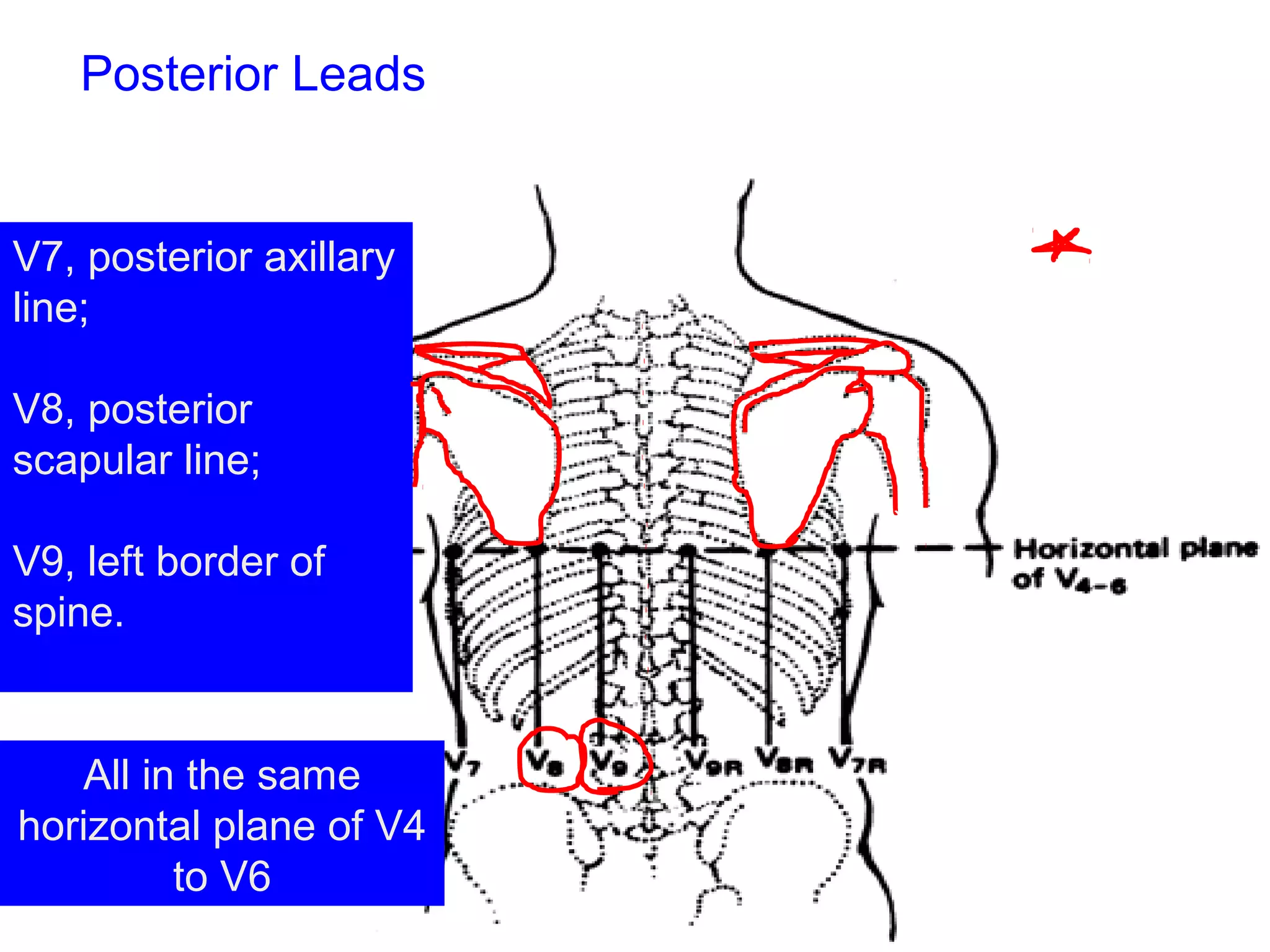 Posterior Leads

V7, posterior axillary
line;
V8, posterior
scapular line;
V9, left border of
spine.

All in the same
horizontal plane of V4
to V6

 