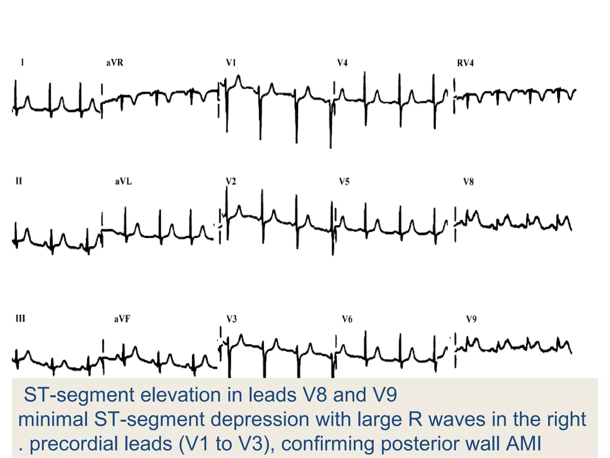 ST-segment elevation in leads V8 and V9
minimal ST-segment depression with large R waves in the right
. precordial leads (V1 to V3), confirming posterior wall AMI

 