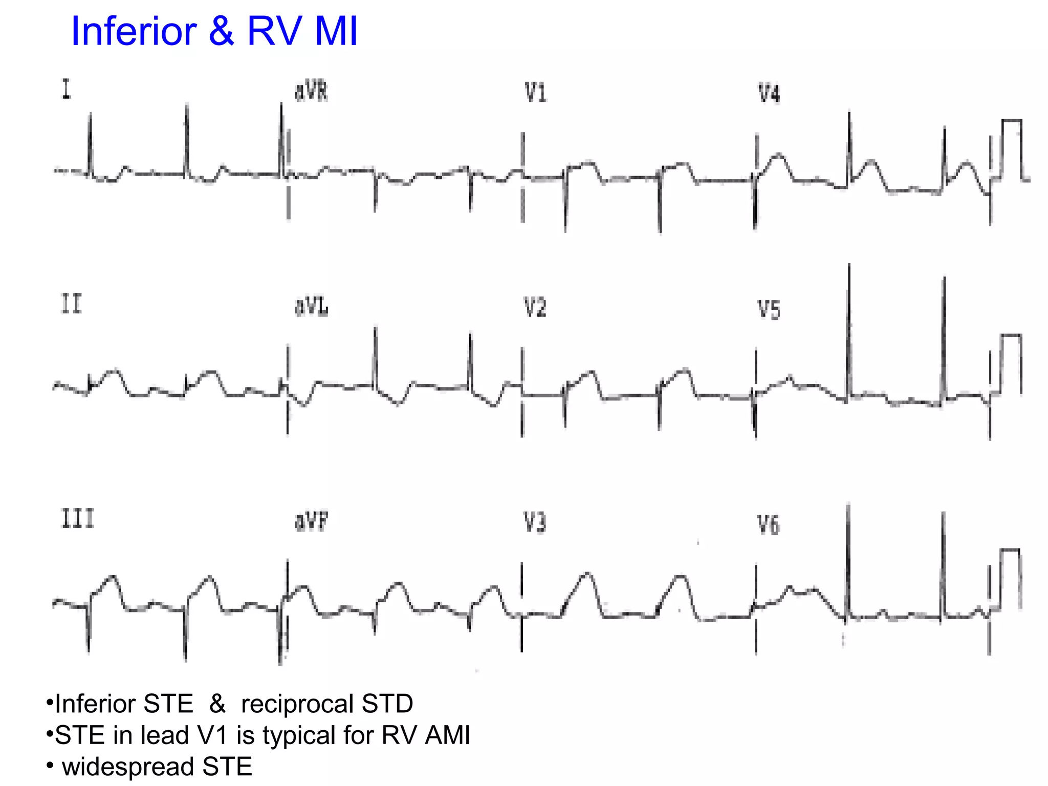 Inferior & RV MI

•Inferior STE  &  reciprocal STD 
•STE in lead V1 is typical for RV AMI 
 
• widespread STE

 