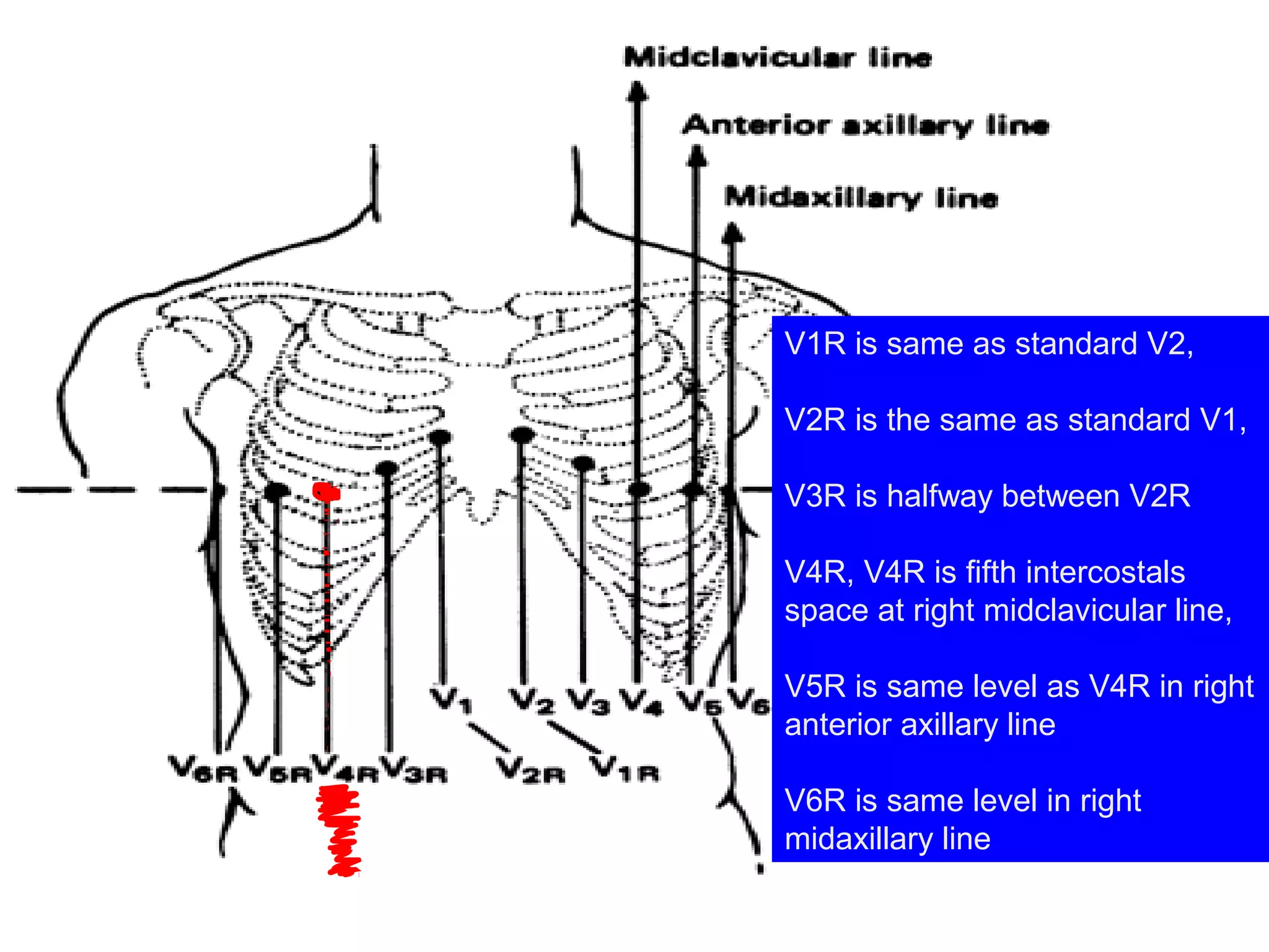 V1R is same as standard V2, 
V2R is the same as standard V1,
V3R is halfway between V2R 
V4R, V4R is fifth intercostals 
space at right midclavicular line,
 
V5R is same level as V4R in right 
anterior axillary line
V6R is same level in right 
midaxillary line

 