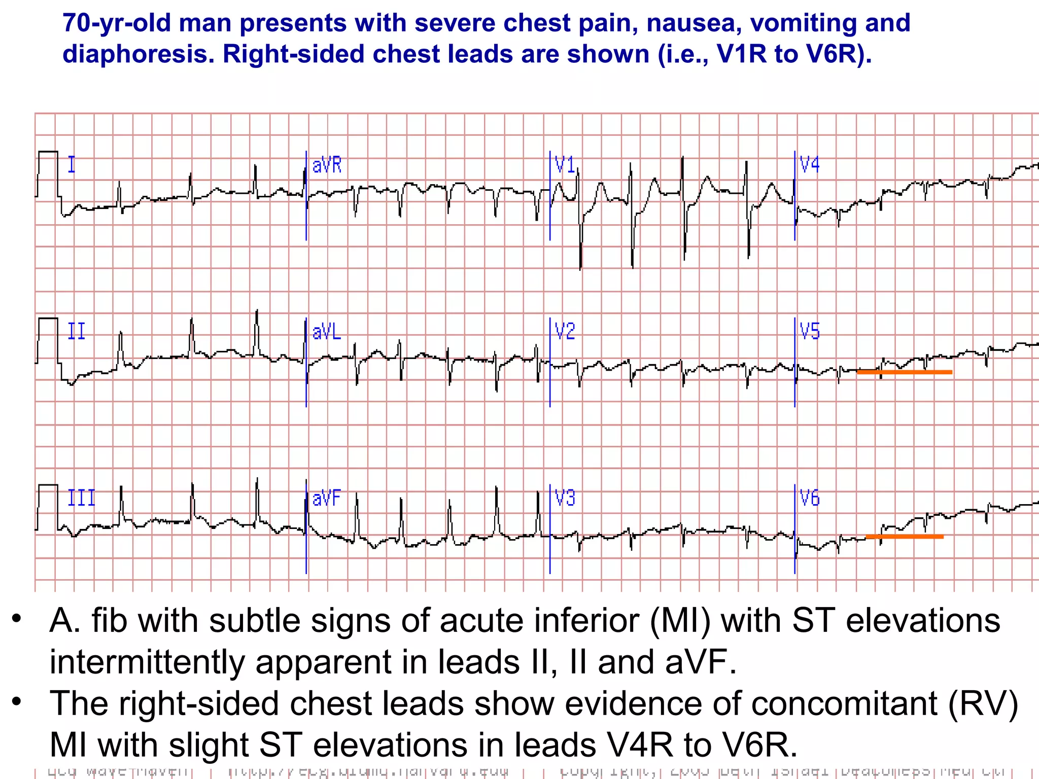 70-yr-old man presents with severe chest pain, nausea, vomiting and
diaphoresis. Right-sided chest leads are shown (i.e., V1R to V6R).

• A. fib with subtle signs of acute inferior (MI) with ST elevations 
intermittently apparent in leads II, II and aVF. 
• The right-sided chest leads show evidence of concomitant (RV) 
MI with slight ST elevations in leads V4R to V6R. 

 