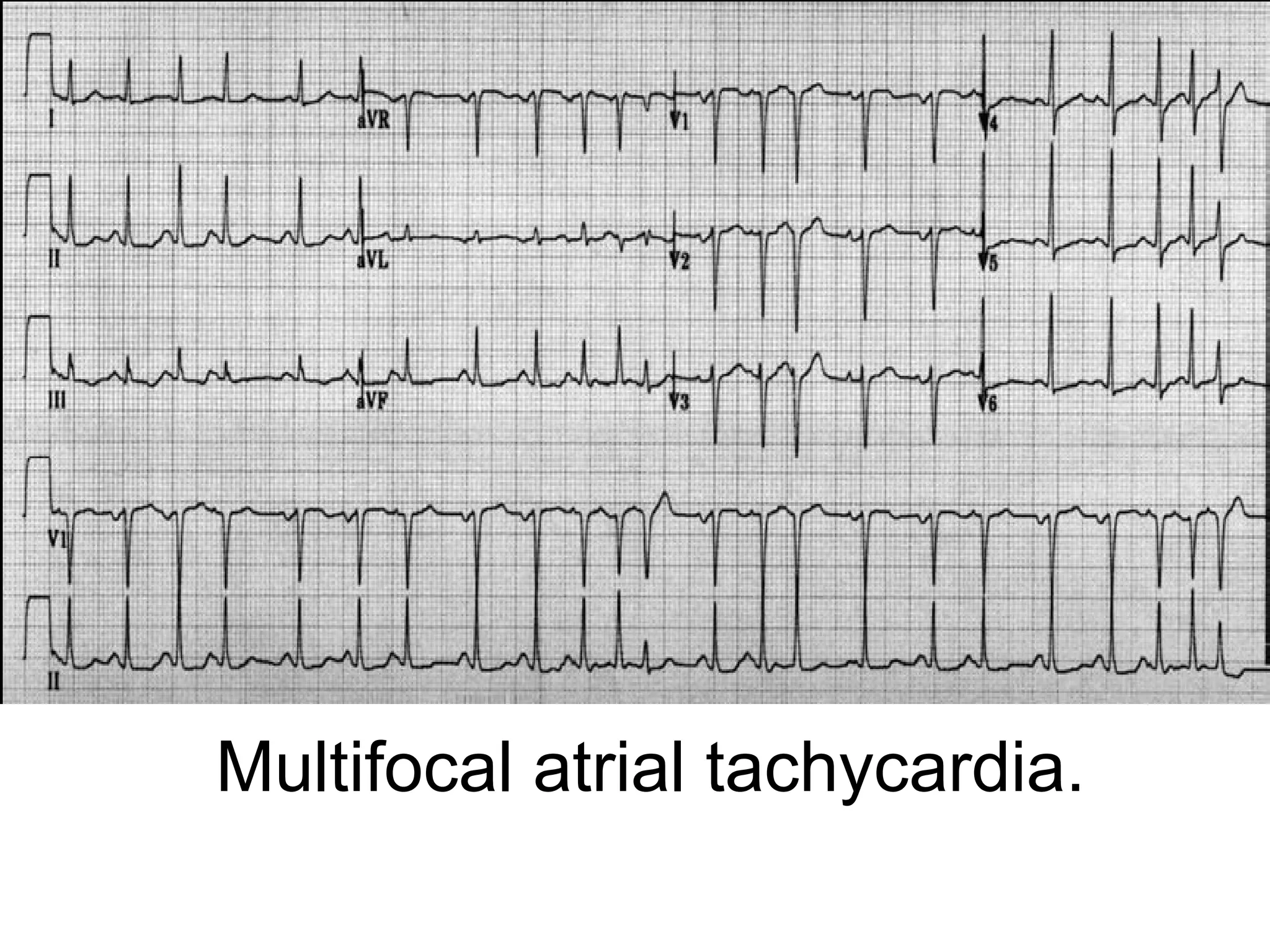 Multifocal atrial tachycardia.

 