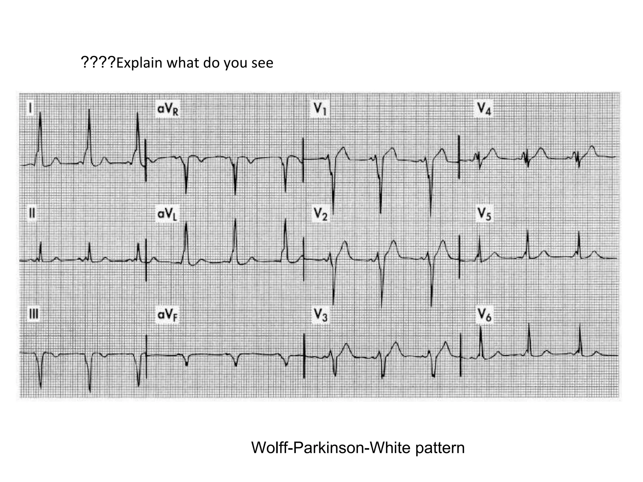 ????Explain what do you see

Wolff-Parkinson-White pattern

 