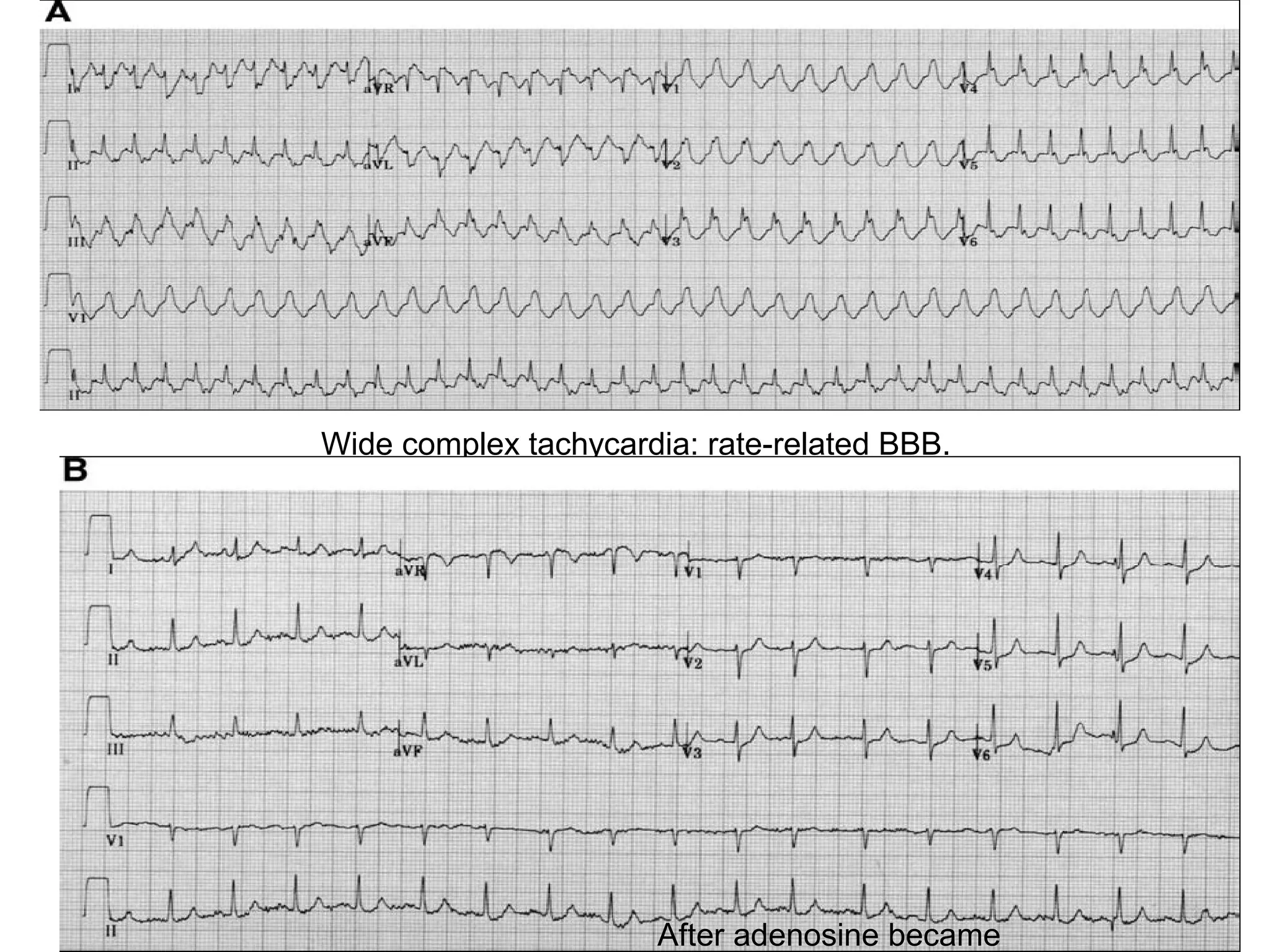 Wide complex tachycardia: rate-related BBB.

After adenosine became

 