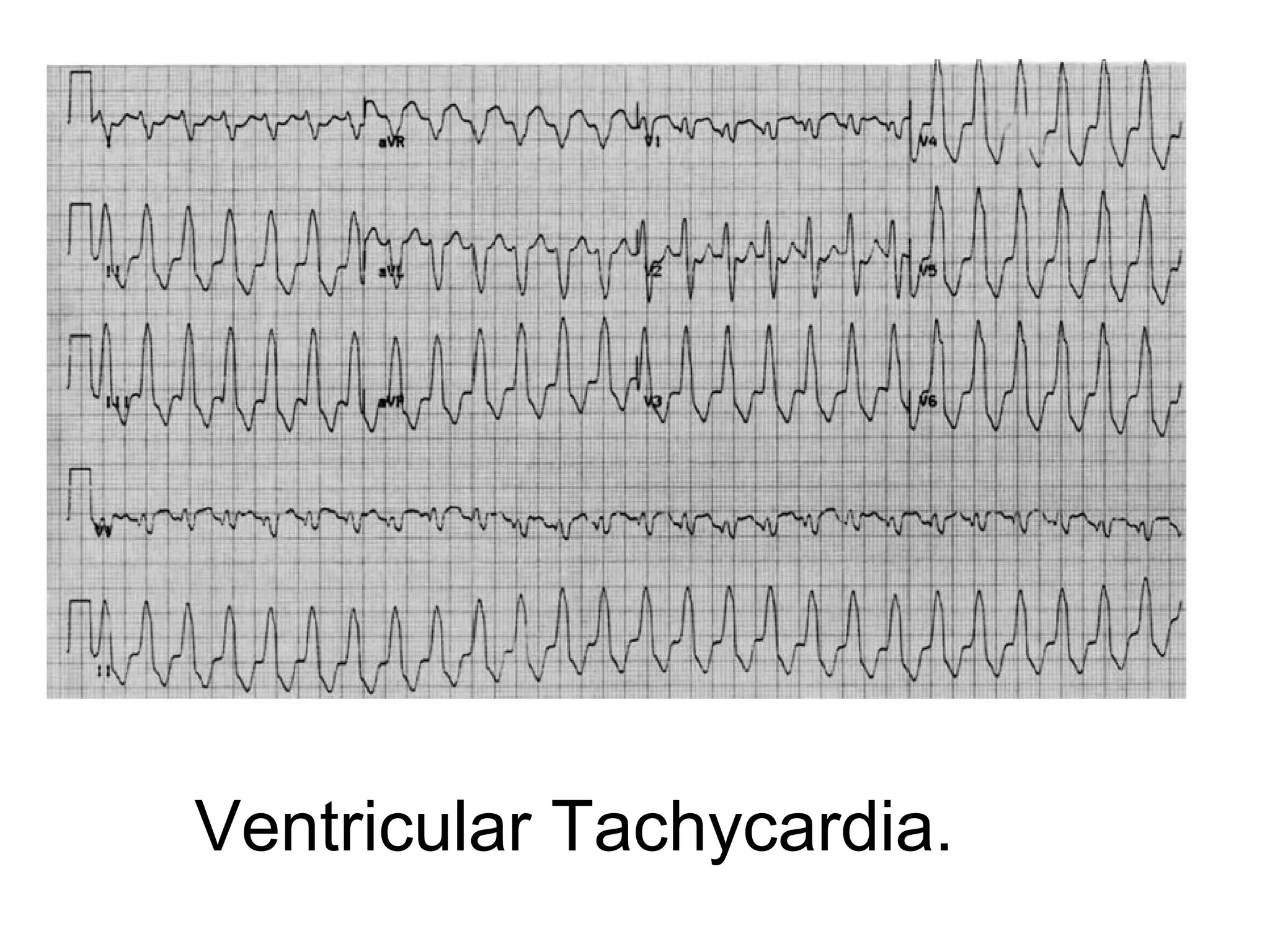 Ventricular Tachycardia.

 