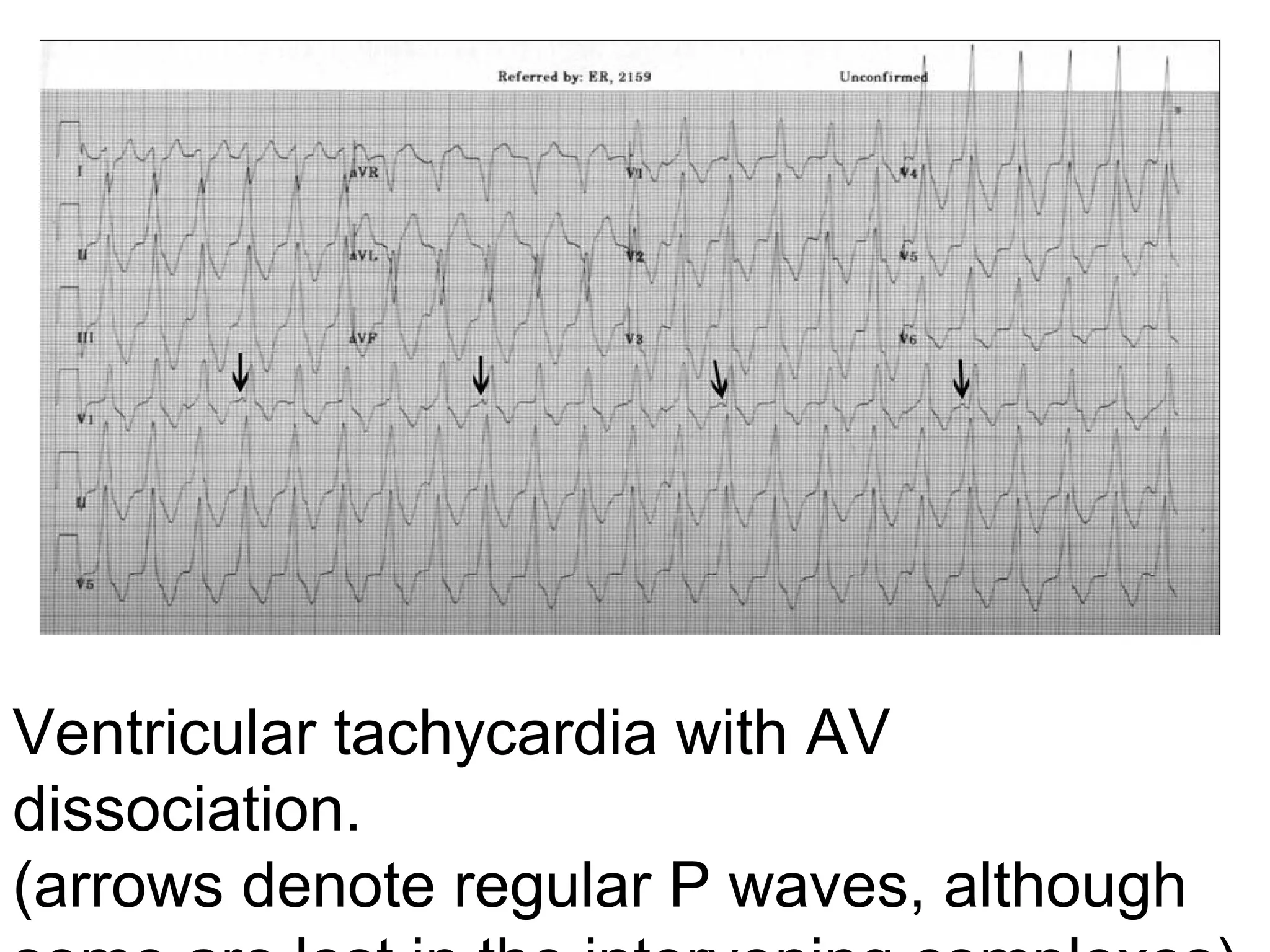 Ventricular tachycardia with AV 
dissociation. 
(arrows denote regular P waves, although 

 