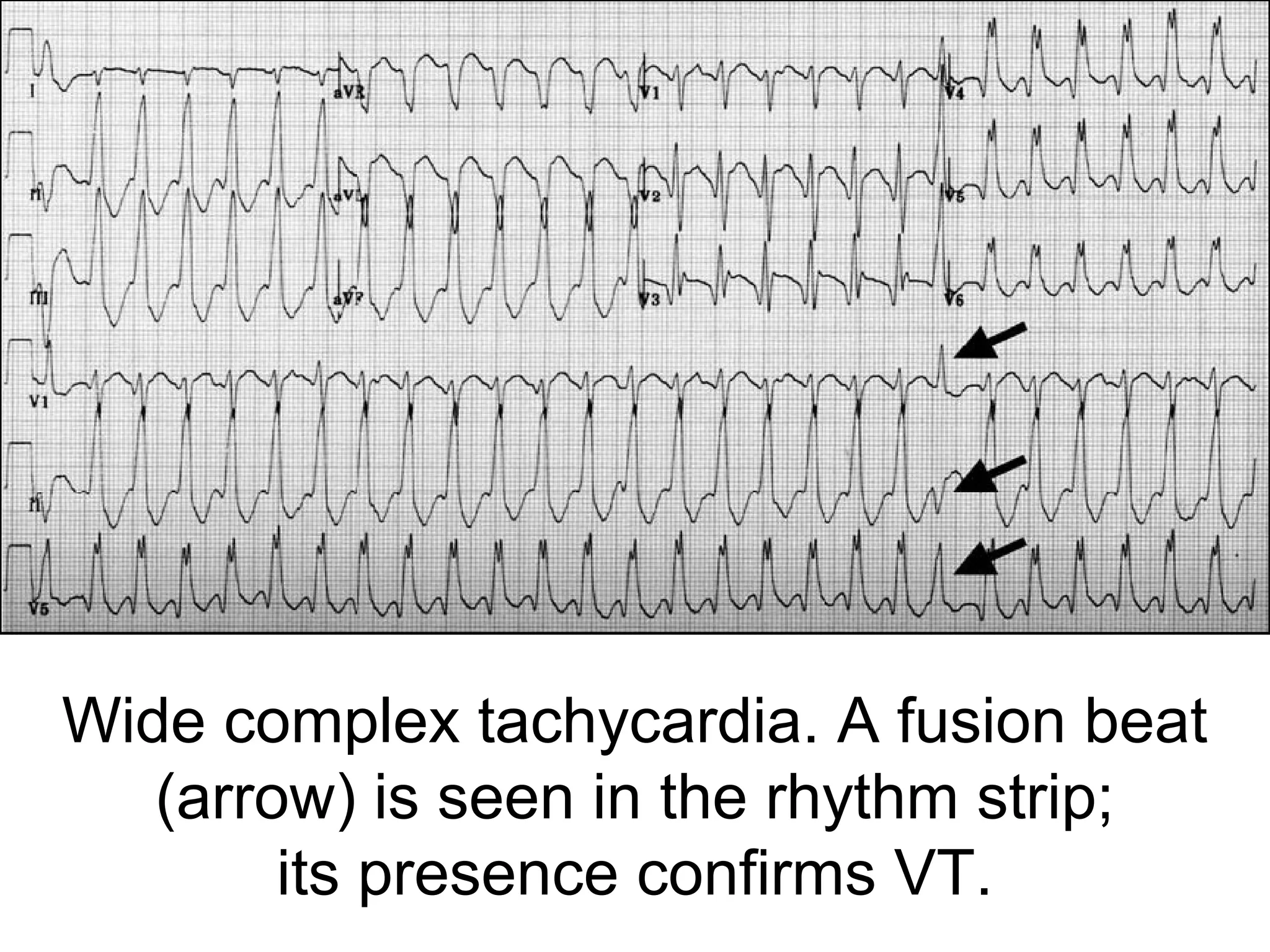 Wide complex tachycardia. A fusion beat 
(arrow) is seen in the rhythm strip;
its presence confirms VT.

 