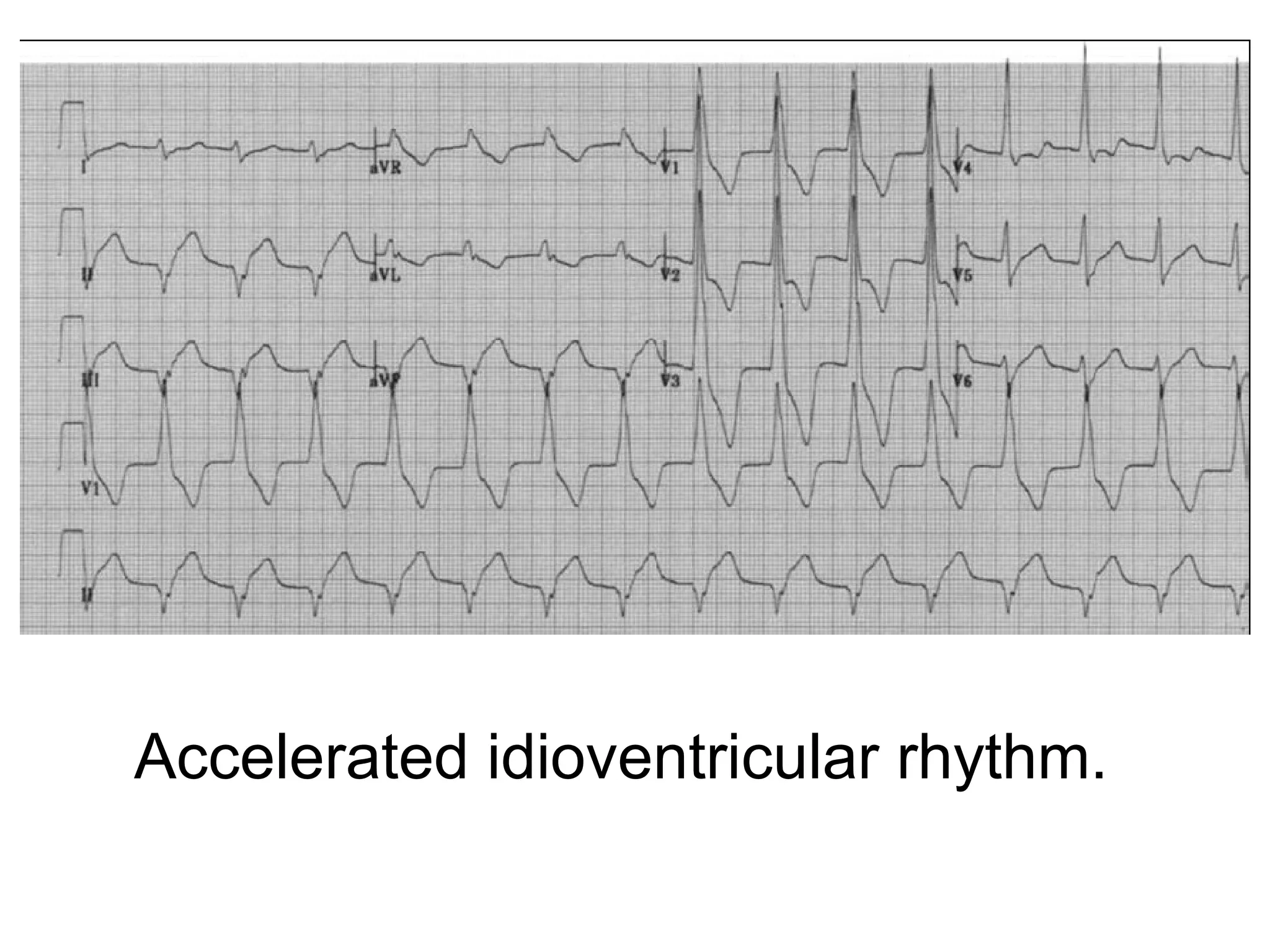 Accelerated idioventricular rhythm. 

 