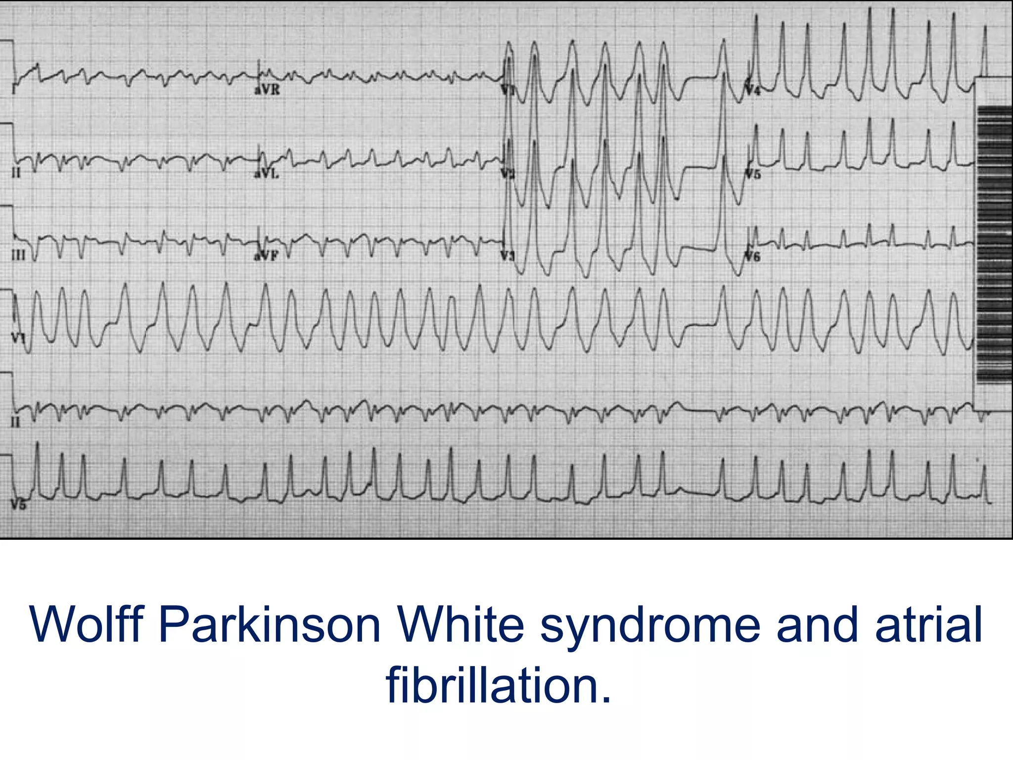 Wolff Parkinson White syndrome and atrial 
fibrillation. 

 