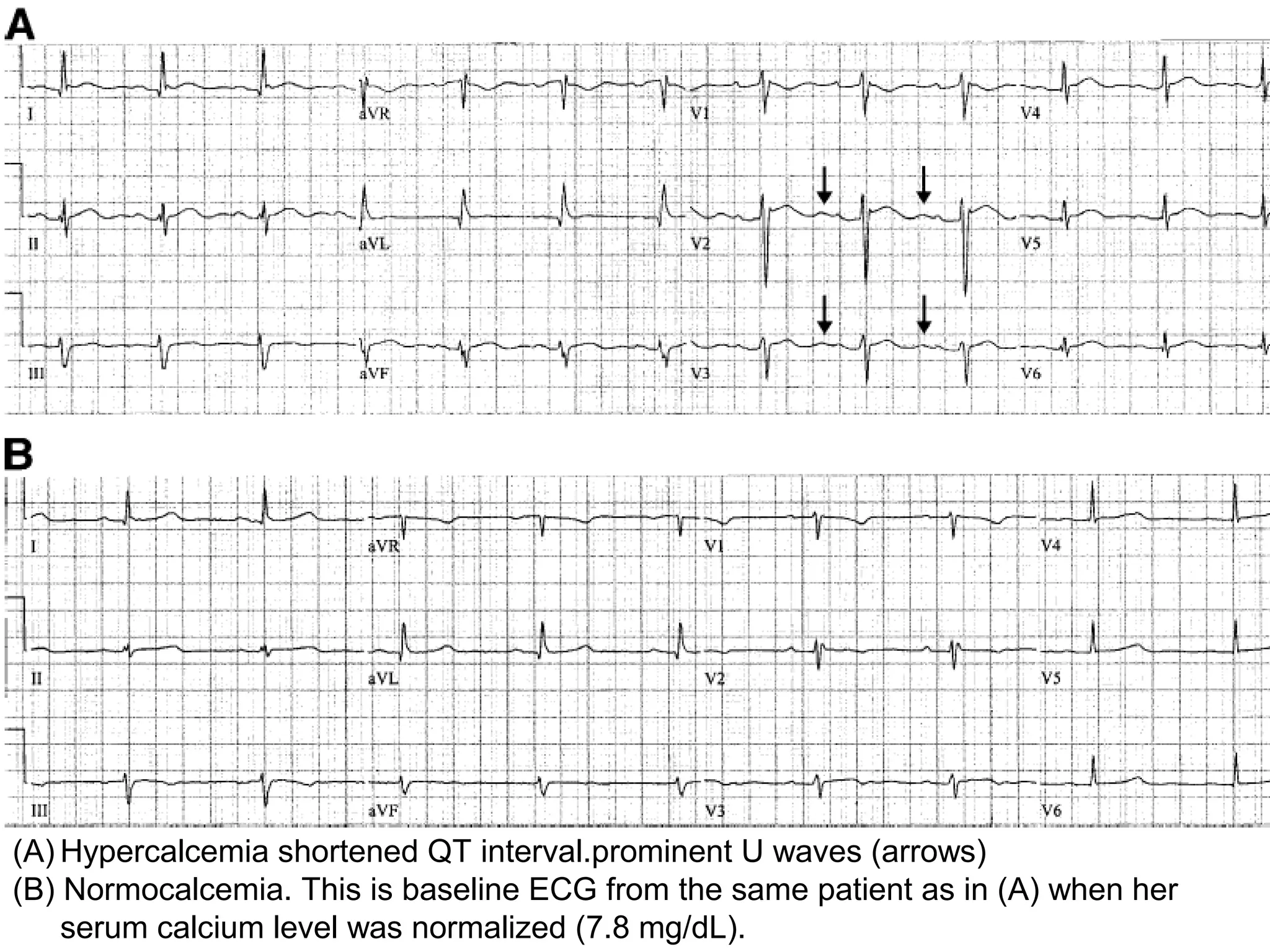 (A) Hypercalcemia shortened QT interval.prominent U waves (arrows) 
(B) Normocalcemia. This is baseline ECG from the same patient as in (A) when her 
serum calcium level was normalized (7.8 mg/dL). 

 