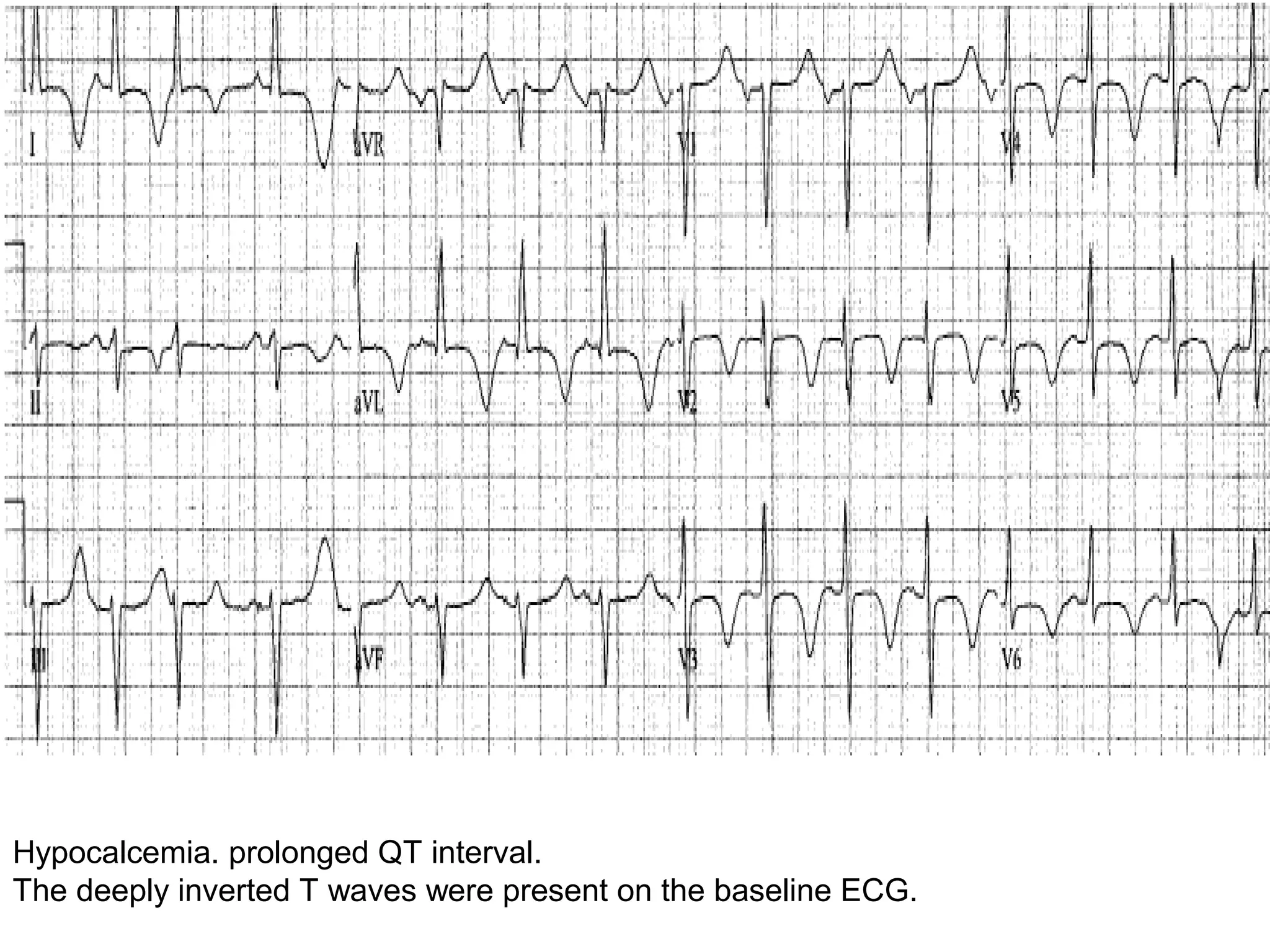 Hypocalcemia. prolonged QT interval. 
The deeply inverted T waves were present on the baseline ECG.

 