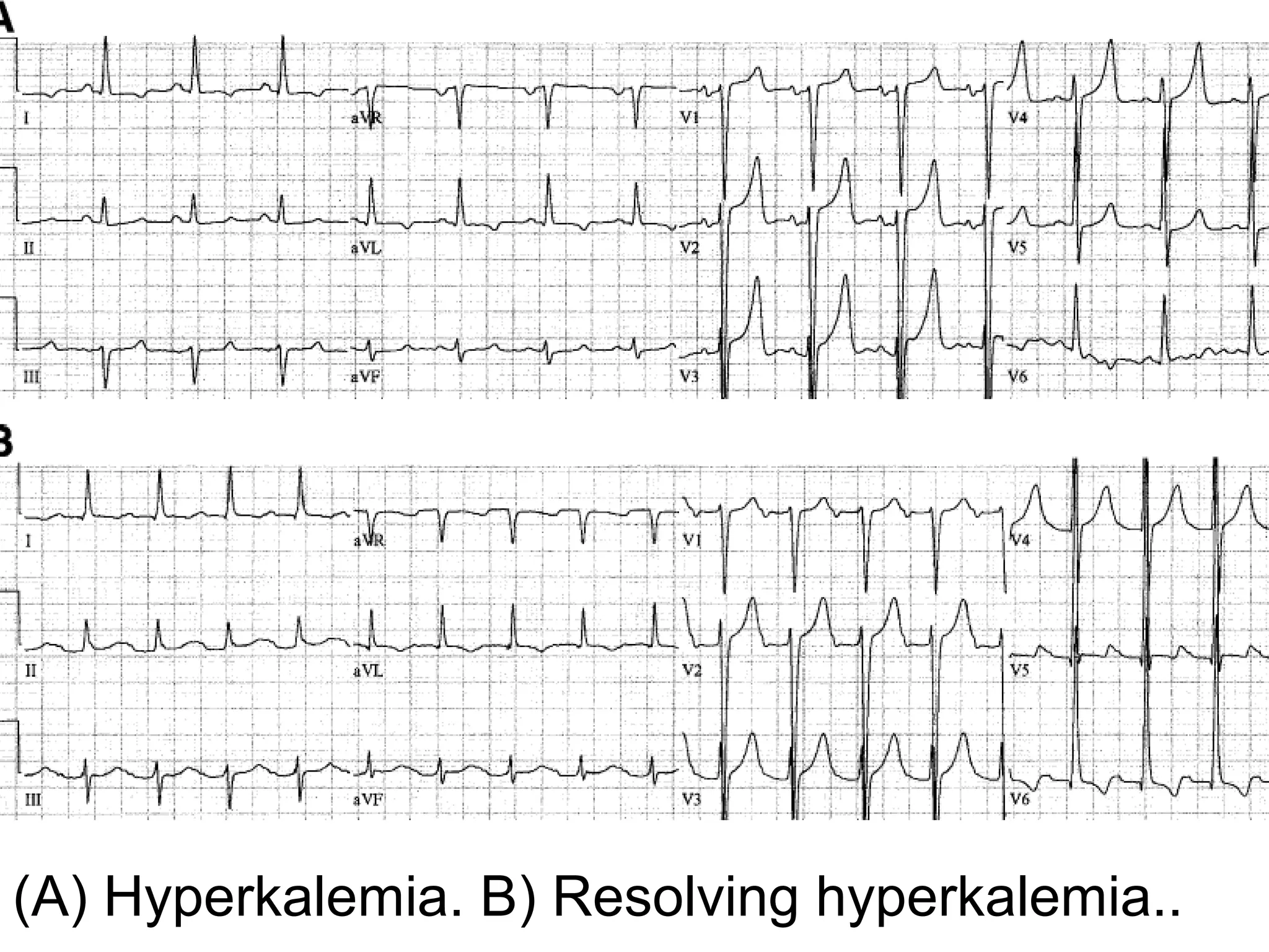 (A) Hyperkalemia. B) Resolving hyperkalemia..

 
