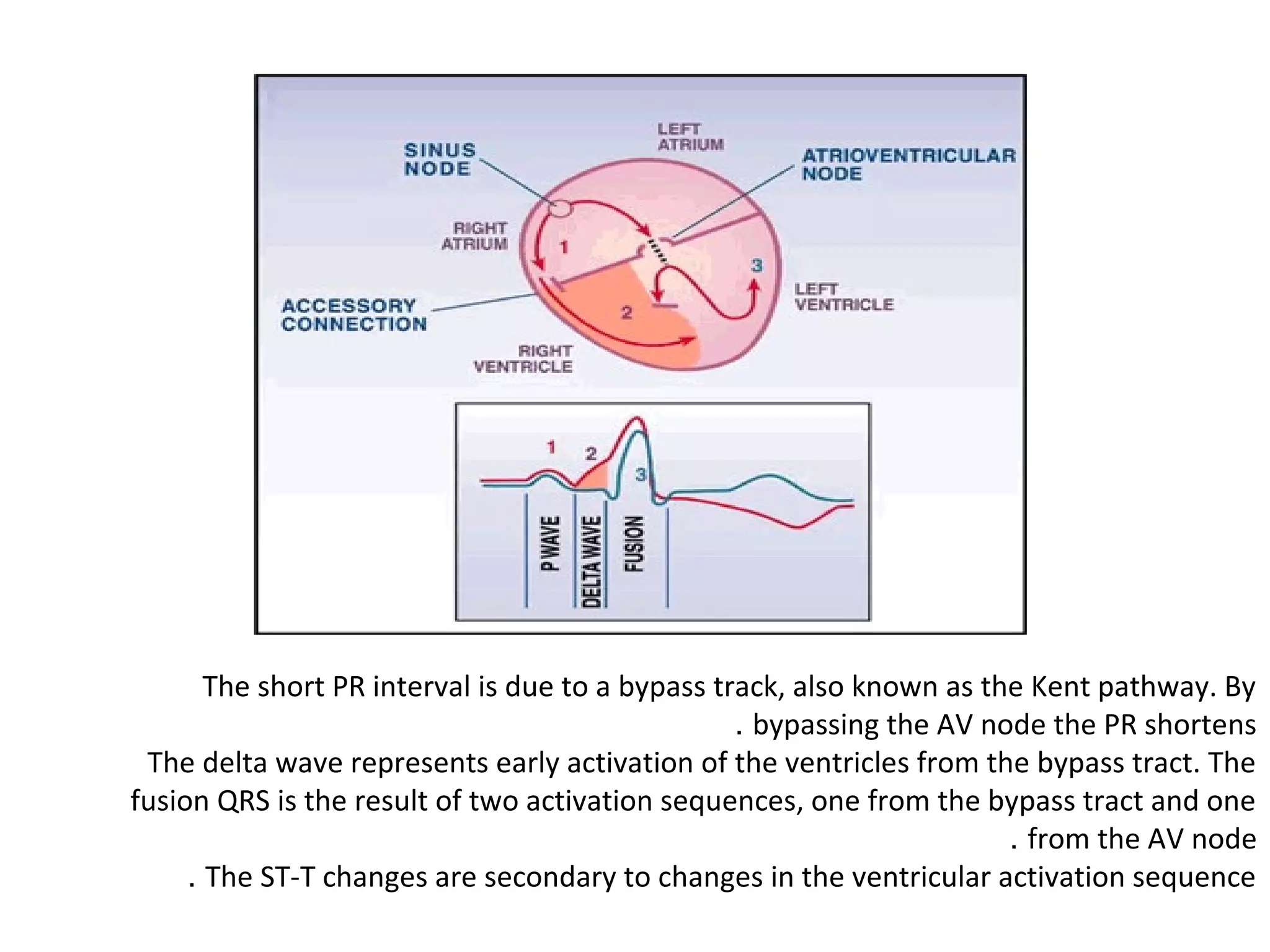 The short PR interval is due to a bypass track, also known as the Kent pathway. By
. bypassing the AV node the PR shortens
The delta wave represents early activation of the ventricles from the bypass tract. The
fusion QRS is the result of two activation sequences, one from the bypass tract and one
. from the AV node
. The ST-T changes are secondary to changes in the ventricular activation sequence

 
