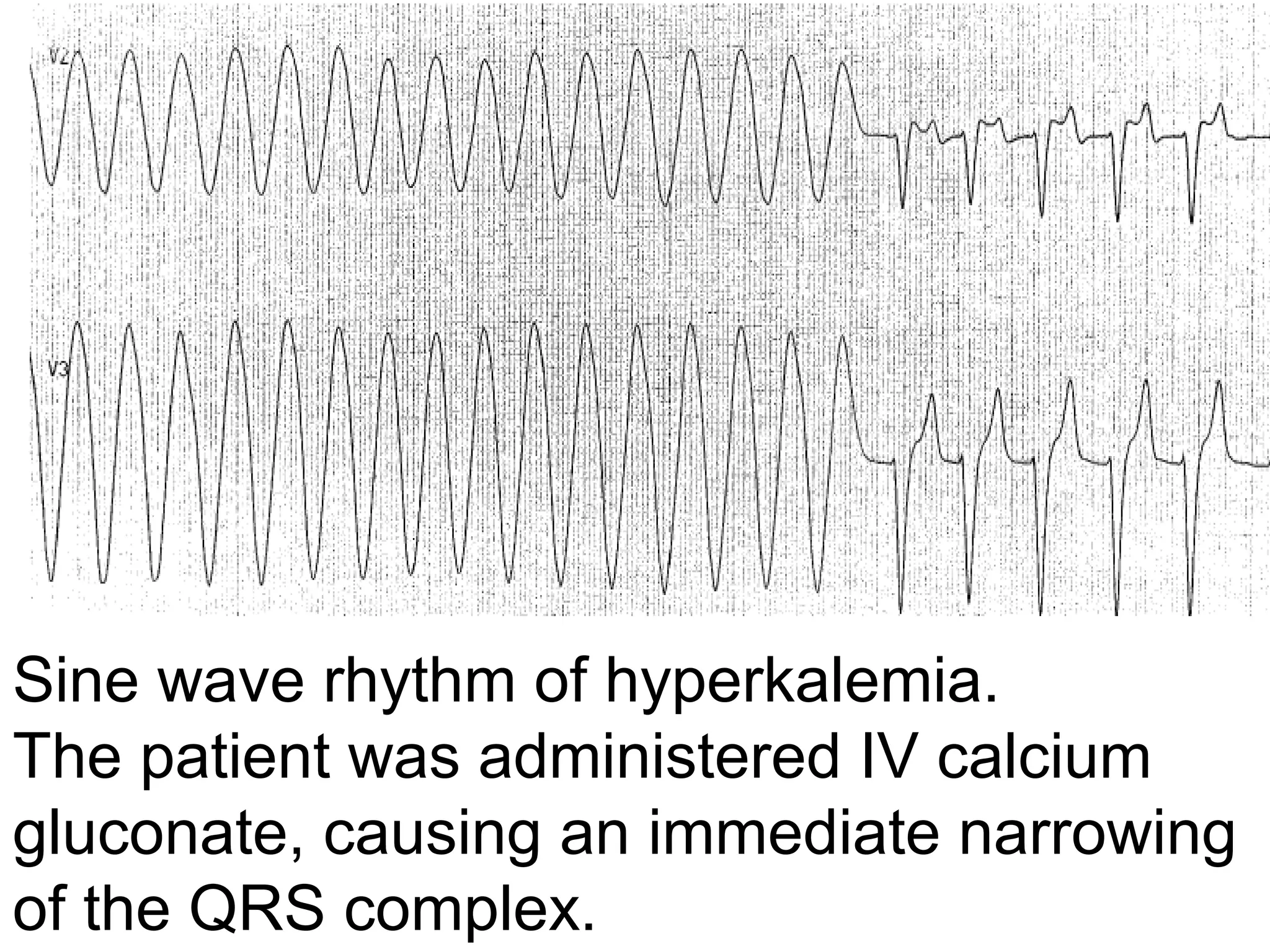 Sine wave rhythm of hyperkalemia. 
The patient was administered IV calcium 
gluconate, causing an immediate narrowing 
of the QRS complex.

 