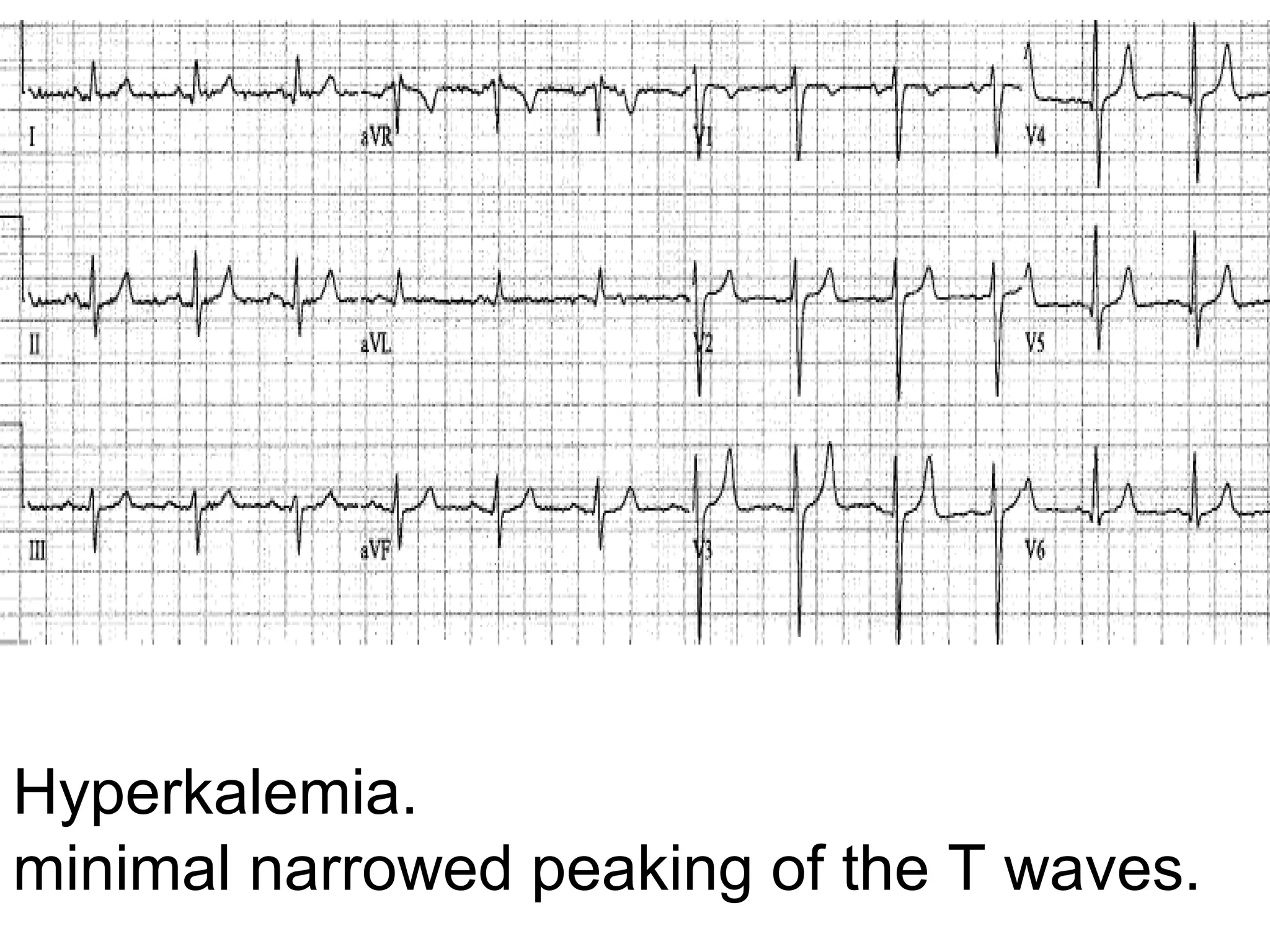 Hyperkalemia. 
minimal narrowed peaking of the T waves. 

 