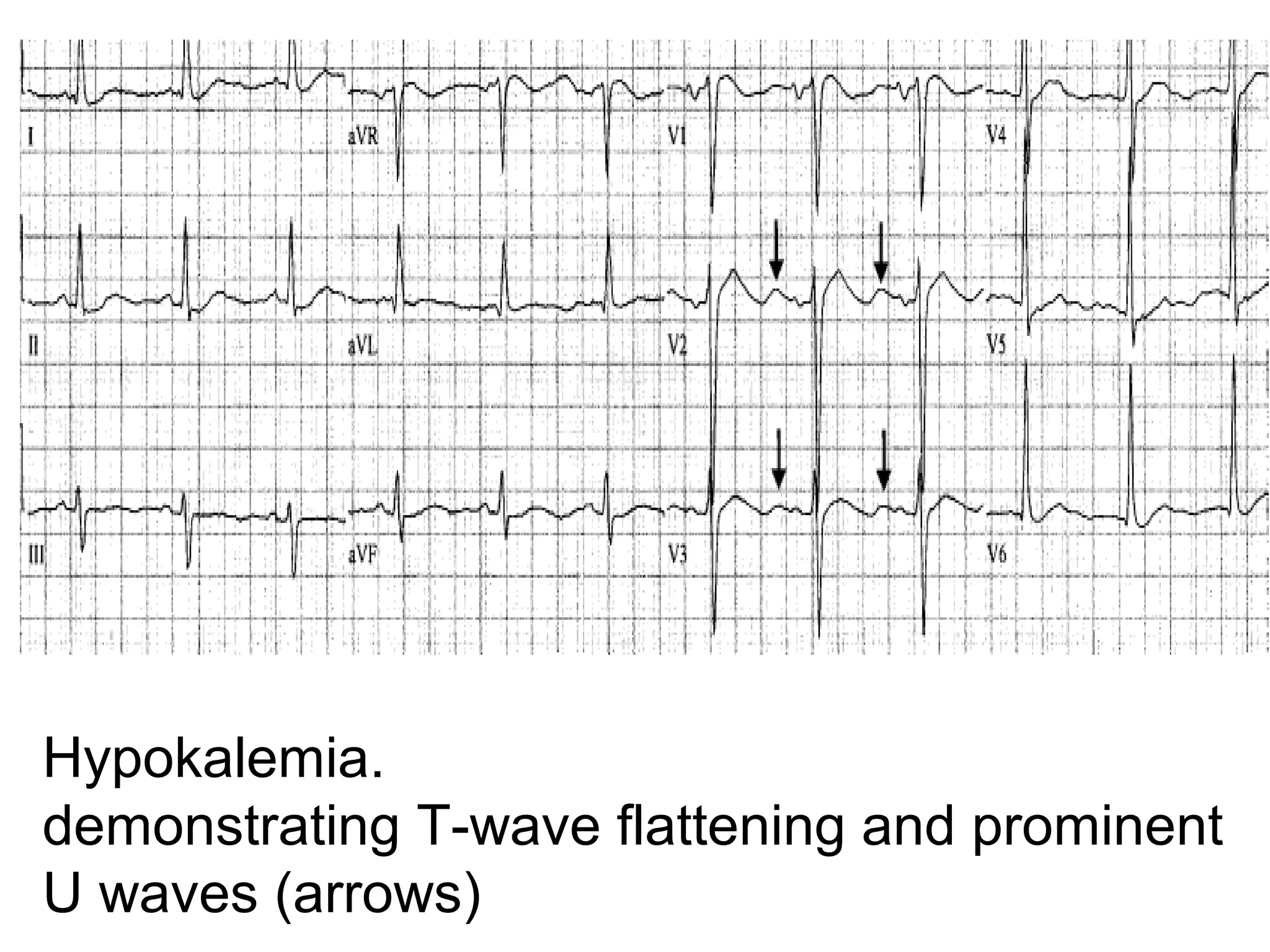 Hypokalemia. 
demonstrating T-wave flattening and prominent 
U waves (arrows)

 