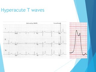 Ecg workshop | PPT