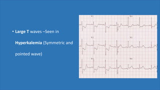 • Large T waves –Seen in
Hyperkalemia (Symmetric and
pointed wave)
 