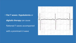 • Flat T waves: Hypokalemia or
digitalis therapy can cause
flattened T waves accompanied
with a prominant U wave
 