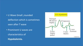 • U Wave-Small ,rounded
deflection which is sometimes
seen after T wave
• Prominent U waves are
characteristics of
Hypokalemia.
 