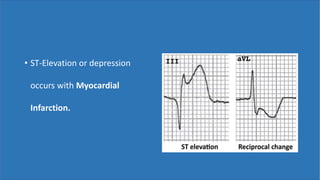 • ST-Elevation or depression
occurs with Myocardial
Infarction.
 