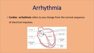 Arrhythmia
• Cardiac arrhythmia refers to any change from the normal sequence
of electrical impulses.
 